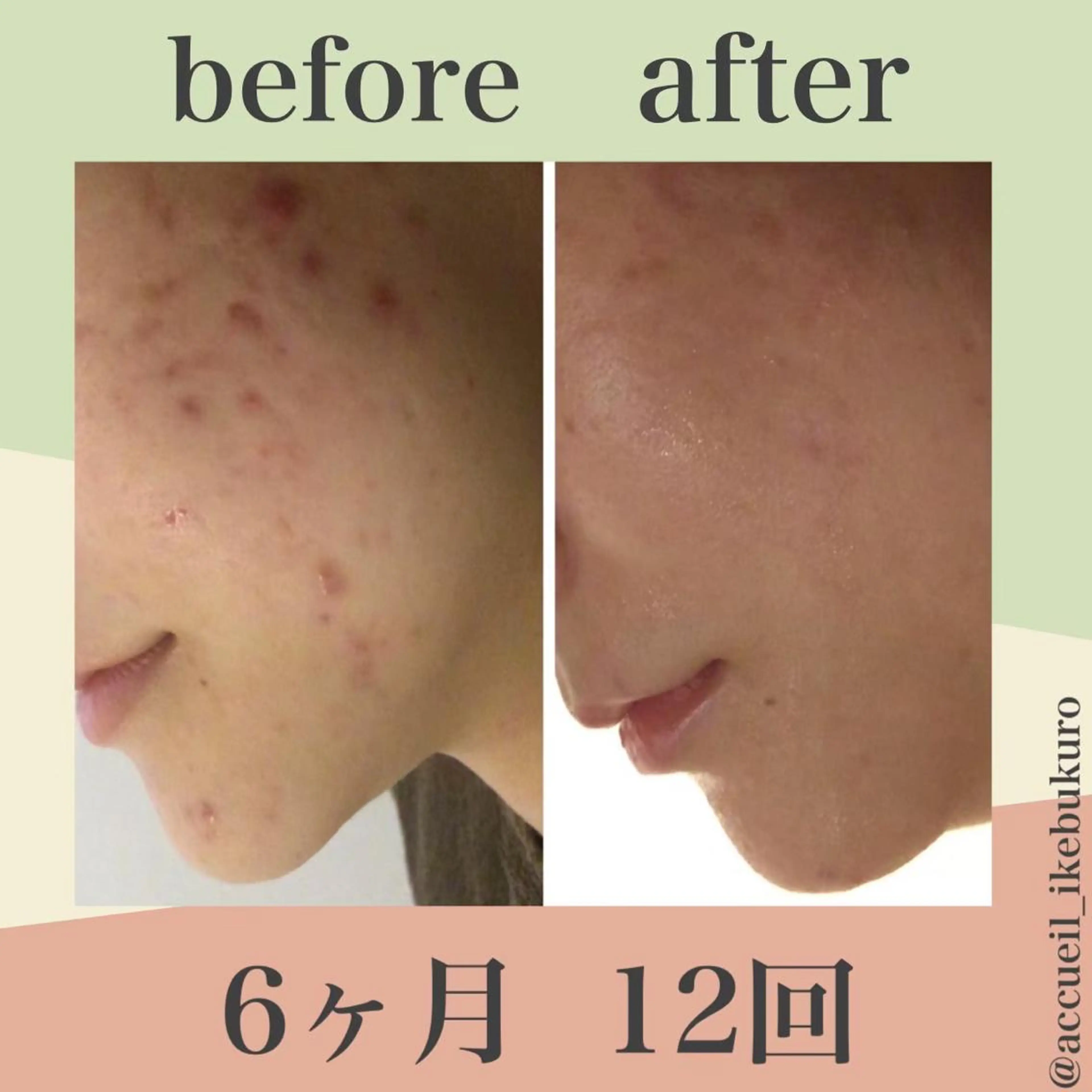 ショート カラー パーマ ヘアアレンジ メンズ キッズ ネイル マツエク・マツパ エステ リラク ニキビ・肌質改善専門 ♡人生が変わるサロンのエステ・リラクイメージ