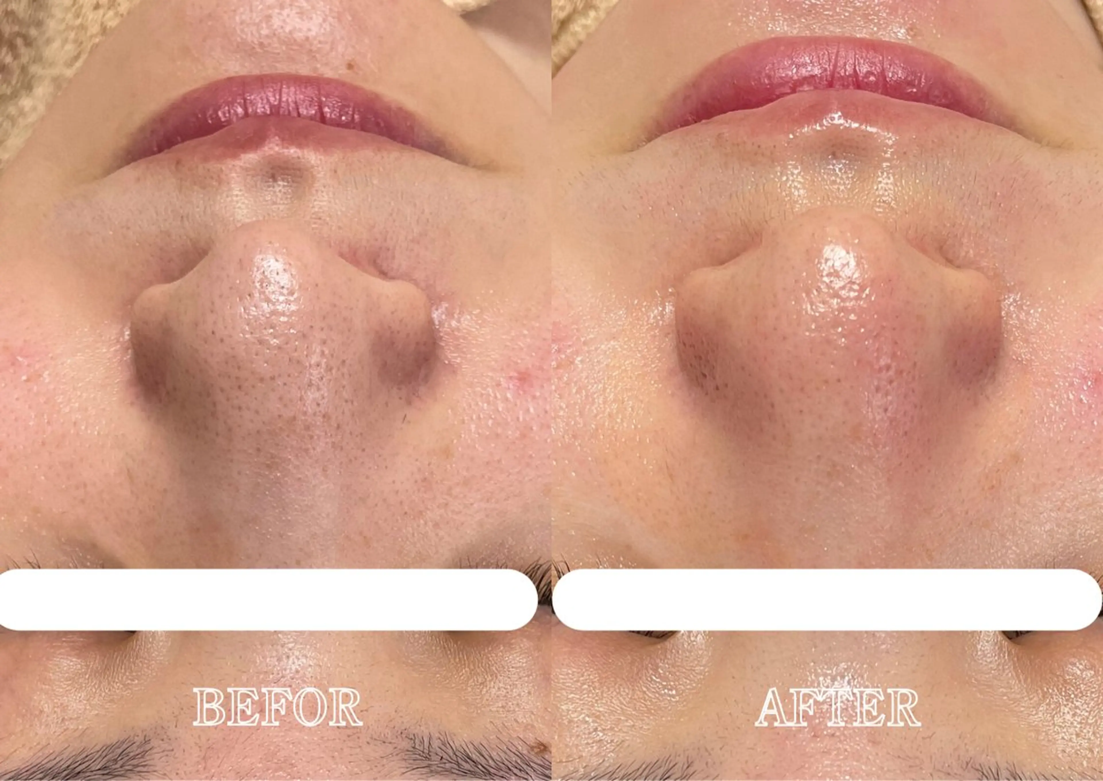 毛穴洗浄🫧ハイドラフェイシャルの写真