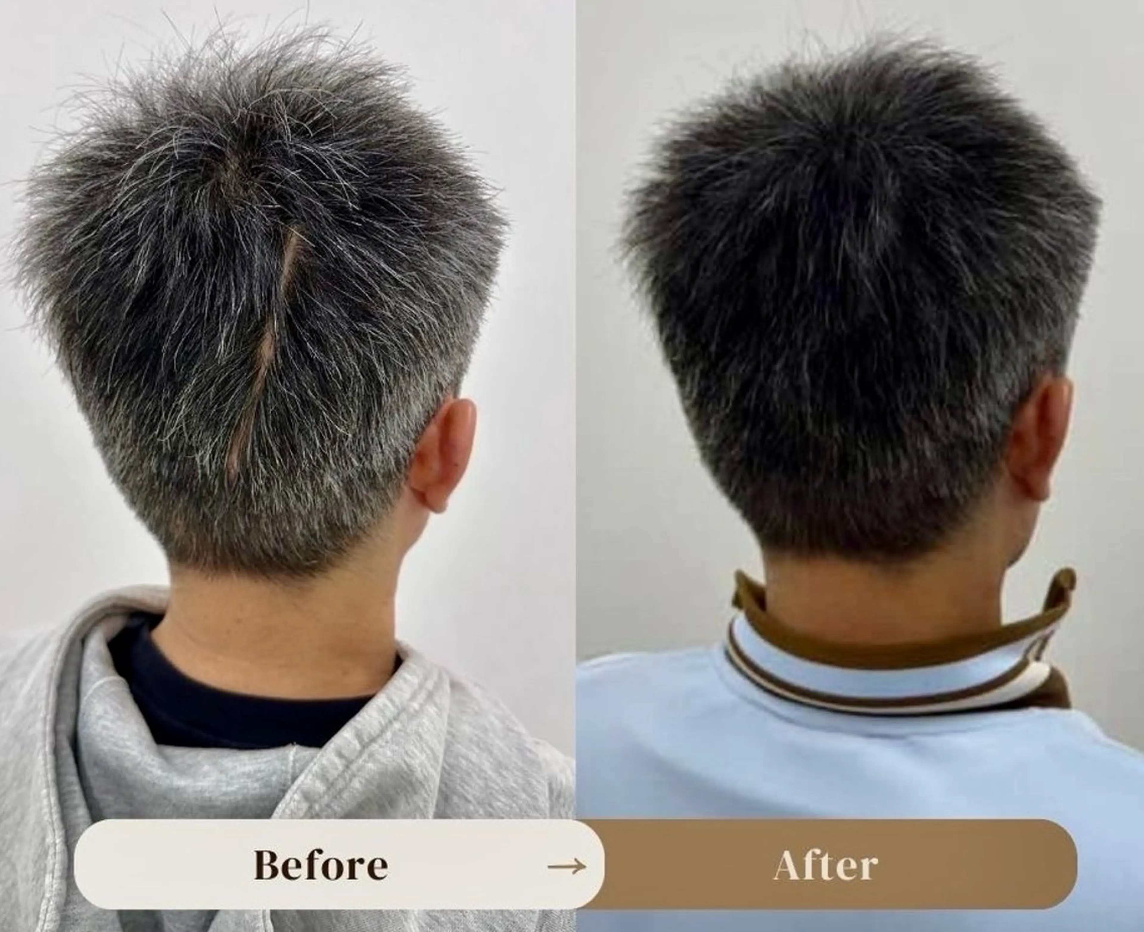 傷跡のお悩み解消ヘアタトゥー（SMP）の写真