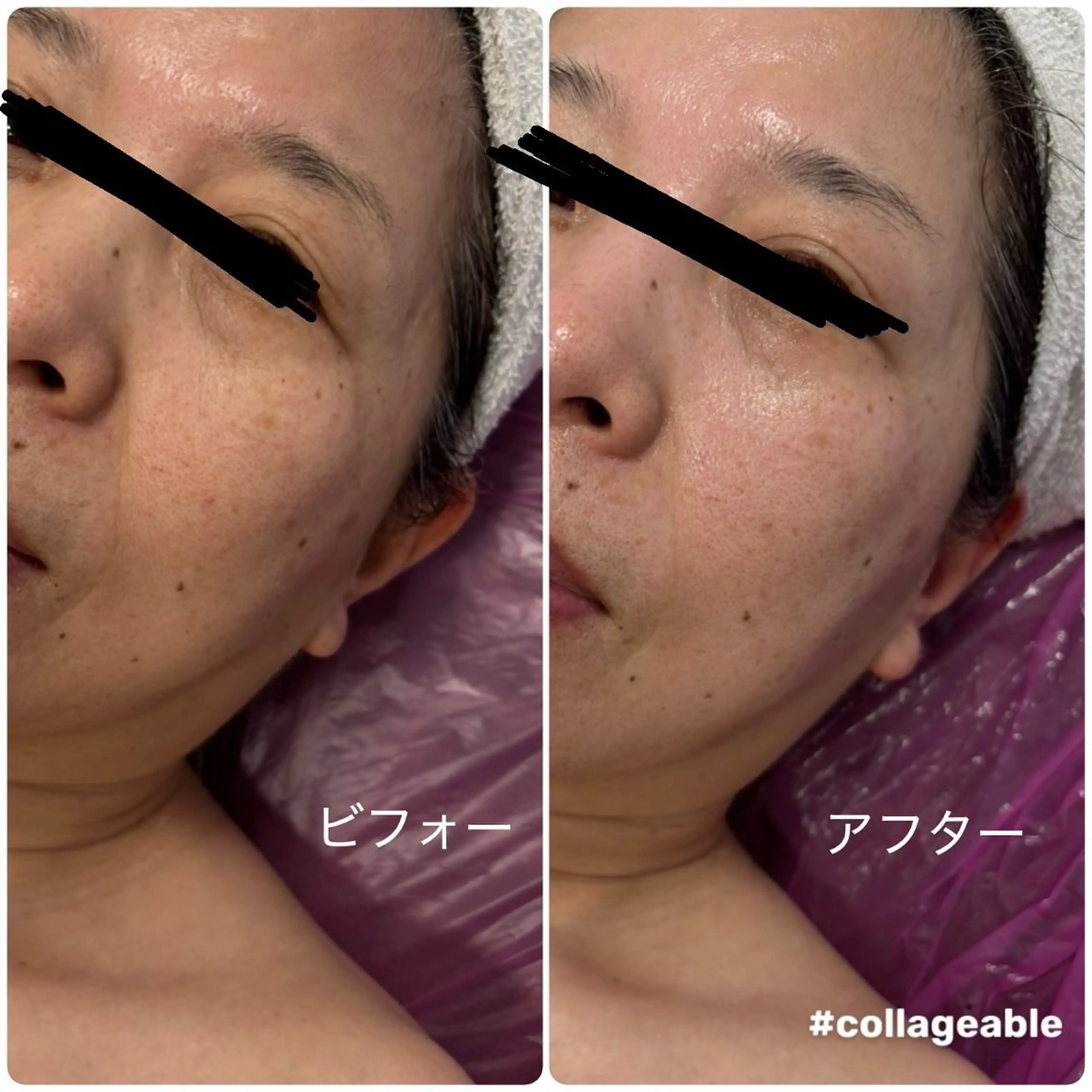 ホワイトビーナスエステで透明感爆誕⛄️期間限定エステ💆♀️の写真