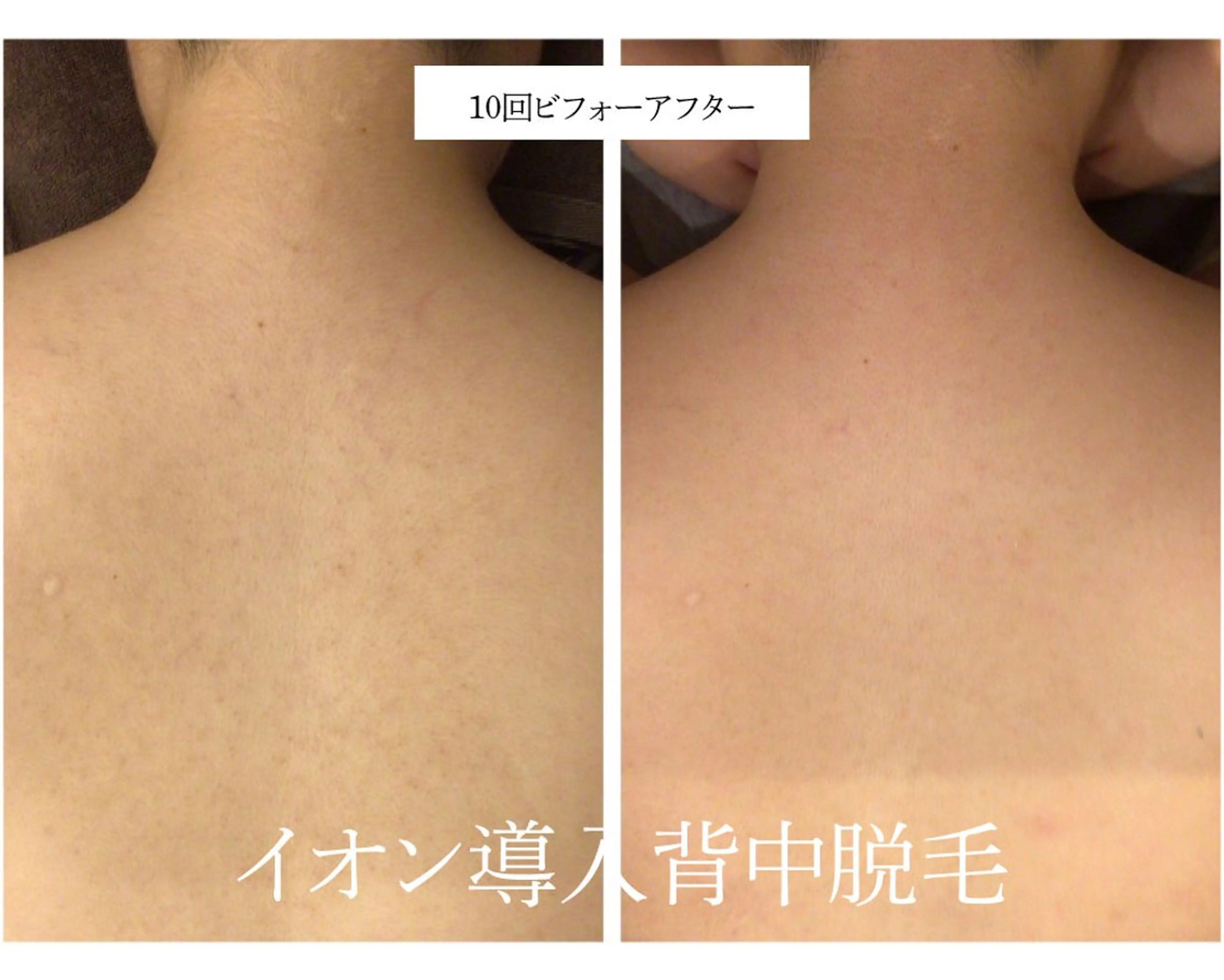 脱毛 🎀うなじ脱毛🎀 ㅣLino堀江のエステ・リラクイメージ