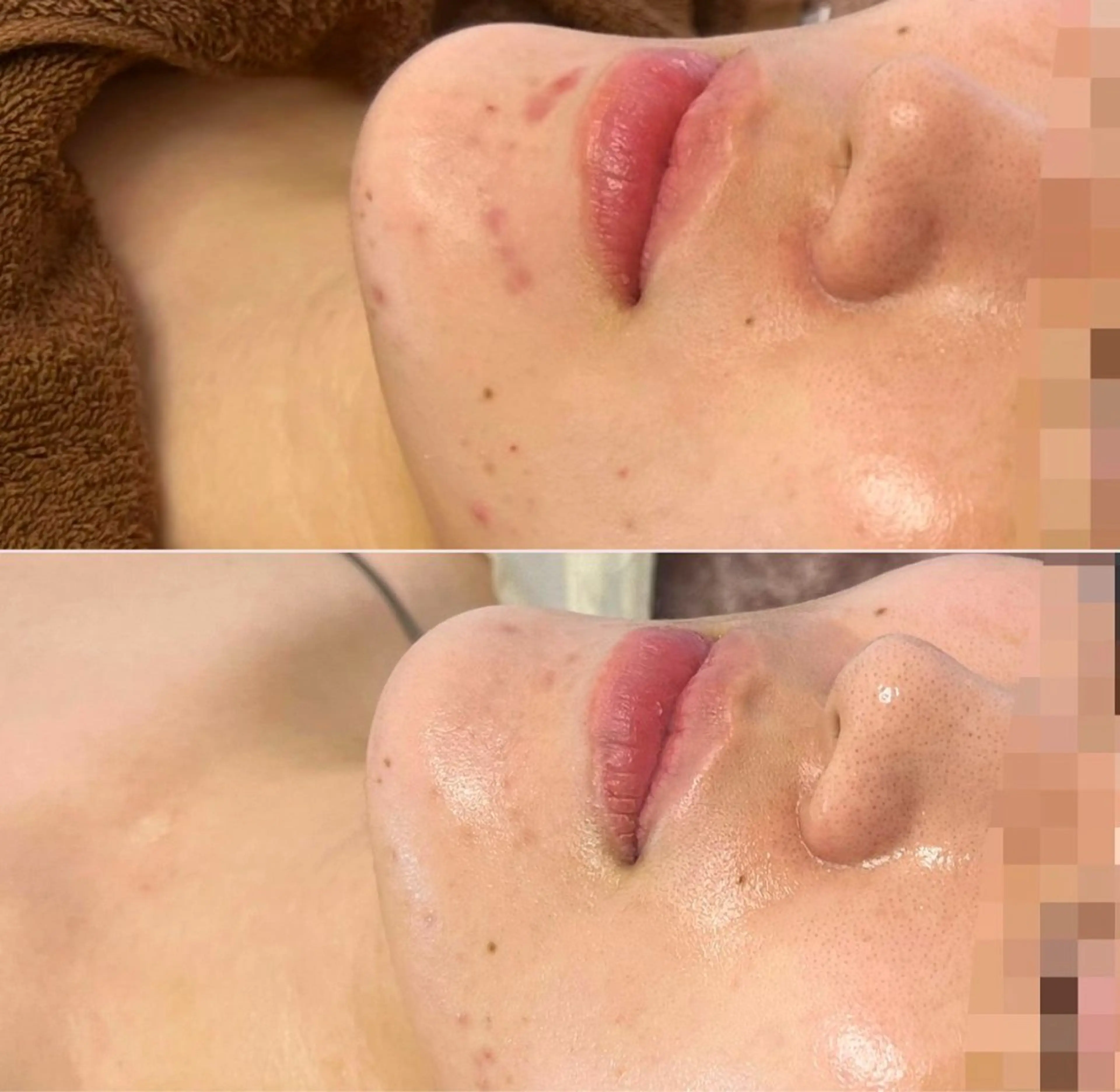 エステ 肌質改善/小顔/ ナスサロ/Yuiのエステ・リラクイメージ