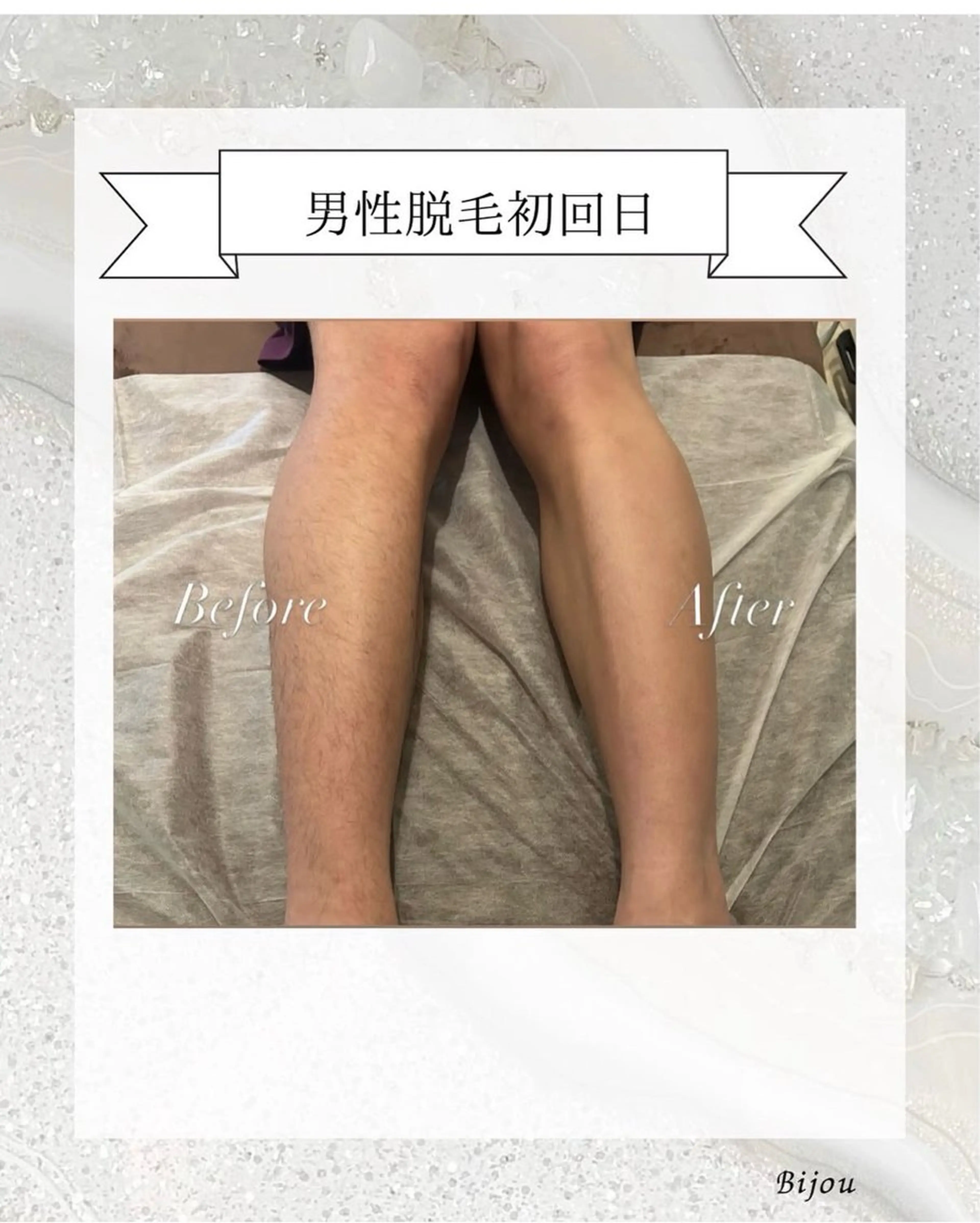 新規様　初回男性🚹全身脱毛9.000円の写真
