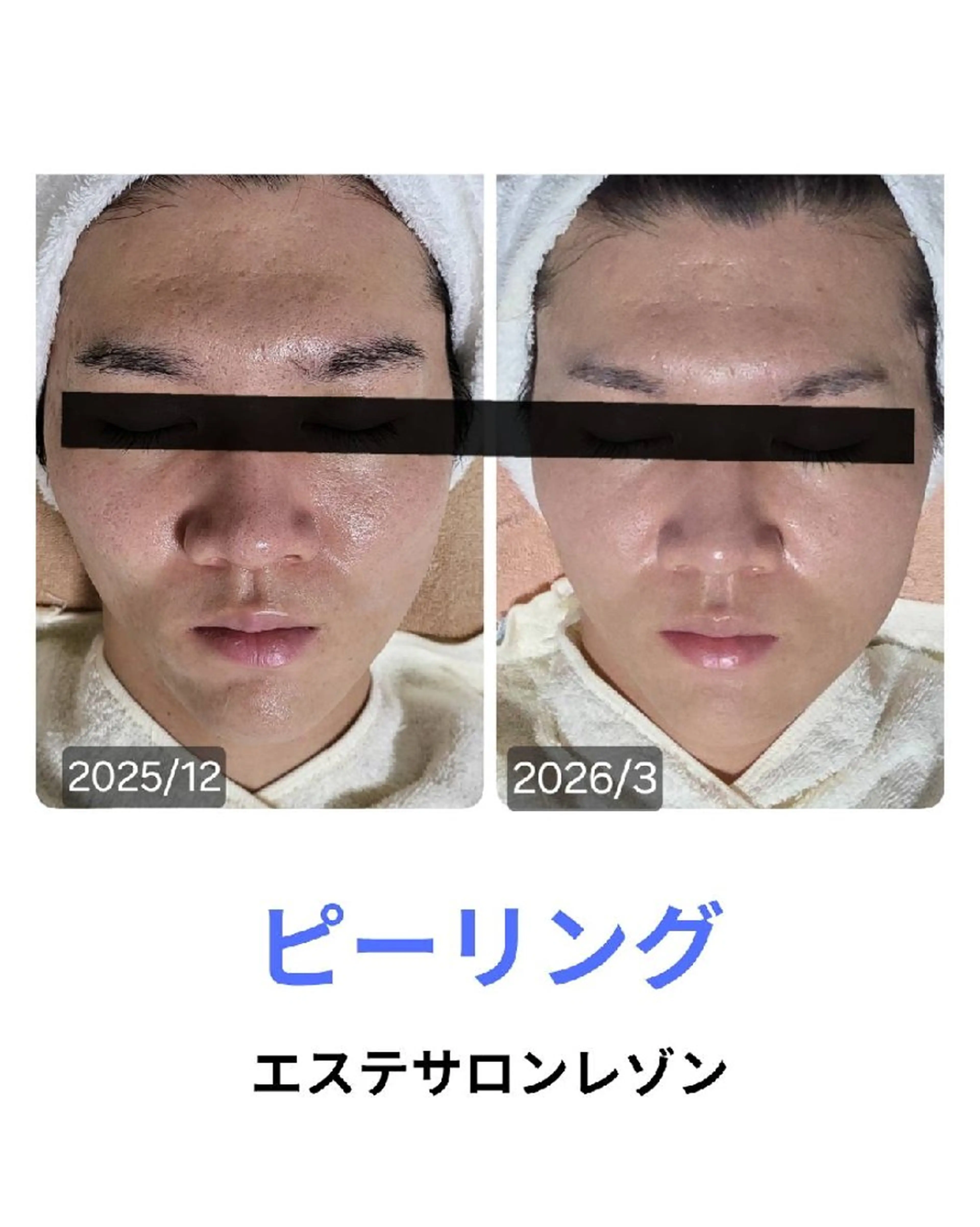 〈ニキビケアサロン〉 レゾン京橋店/ 浅川のエステ・リラクイメージ