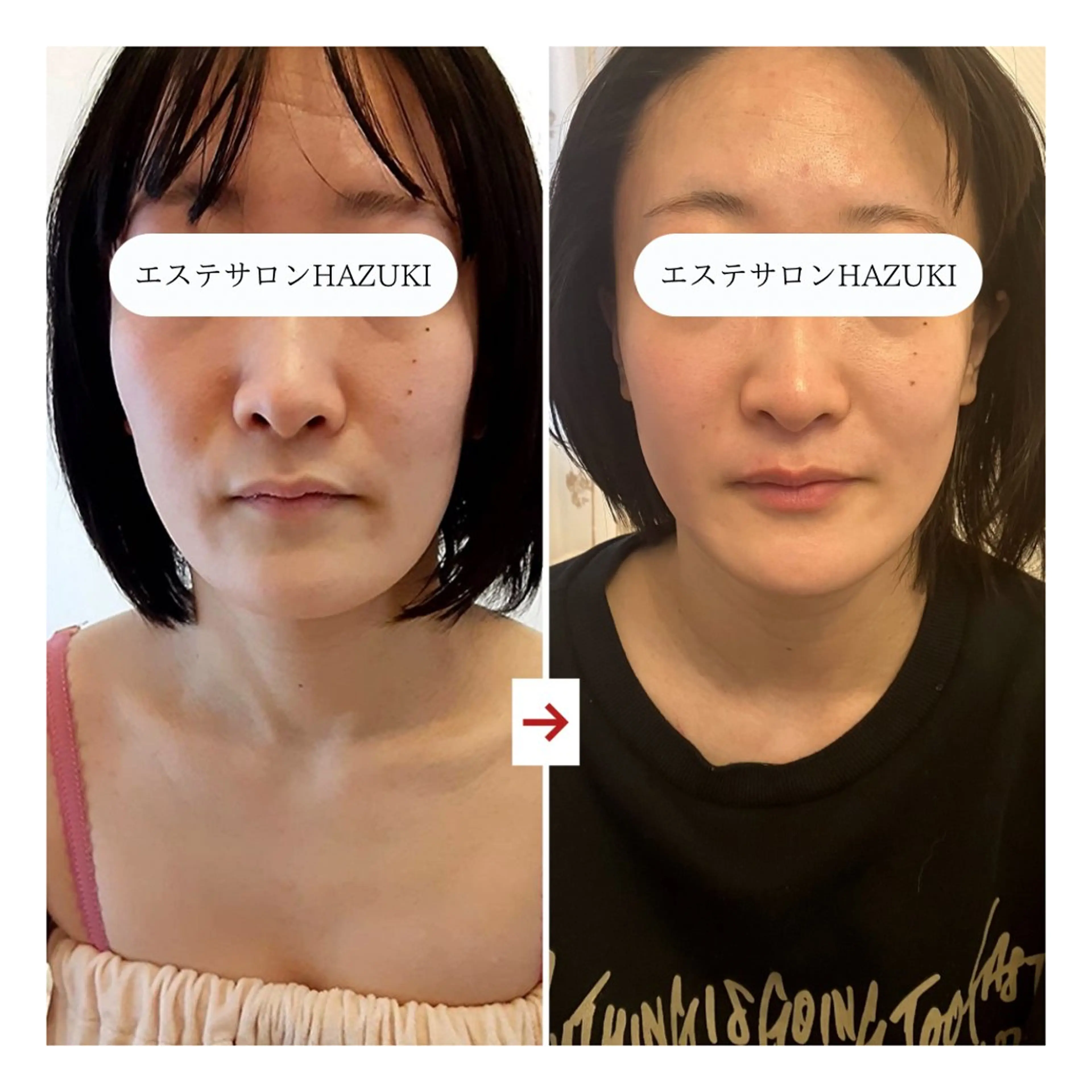 その他 たるみ改善小顔エステ 堀葉月のその他イメージ