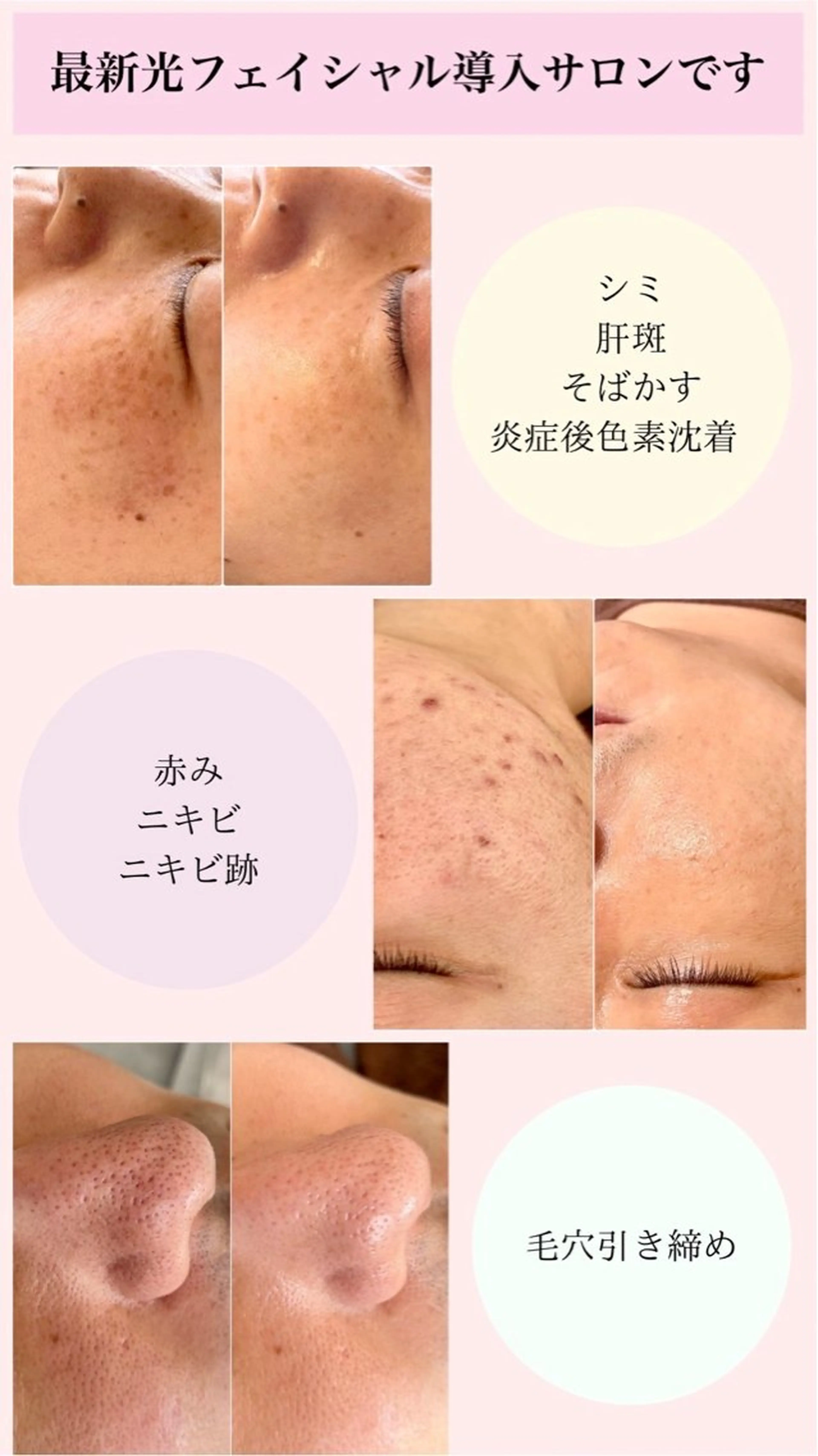 光エステでシミ取り肌質改善！の写真