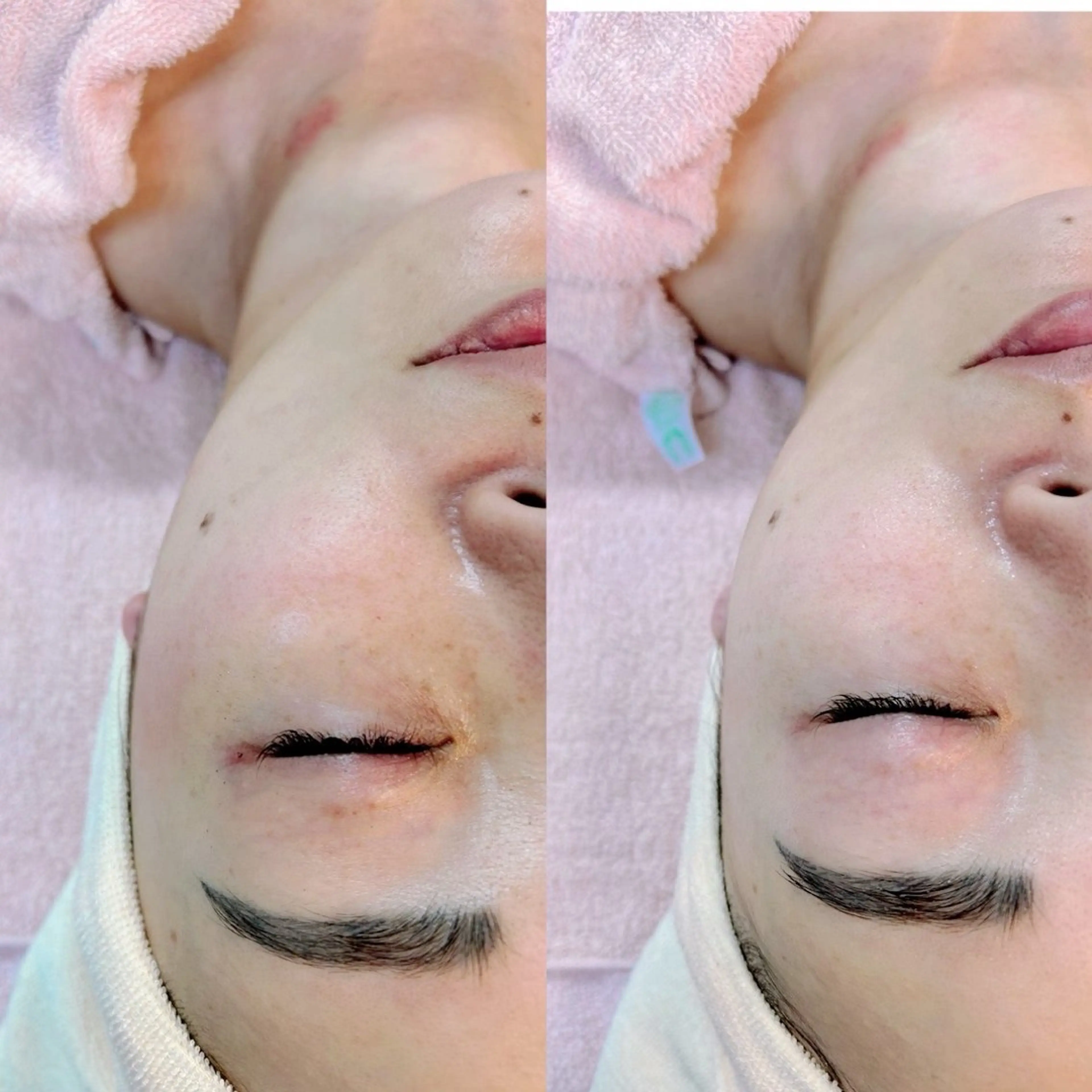 乾燥、目元小ジワ、ほうれい線、黄くすみの写真