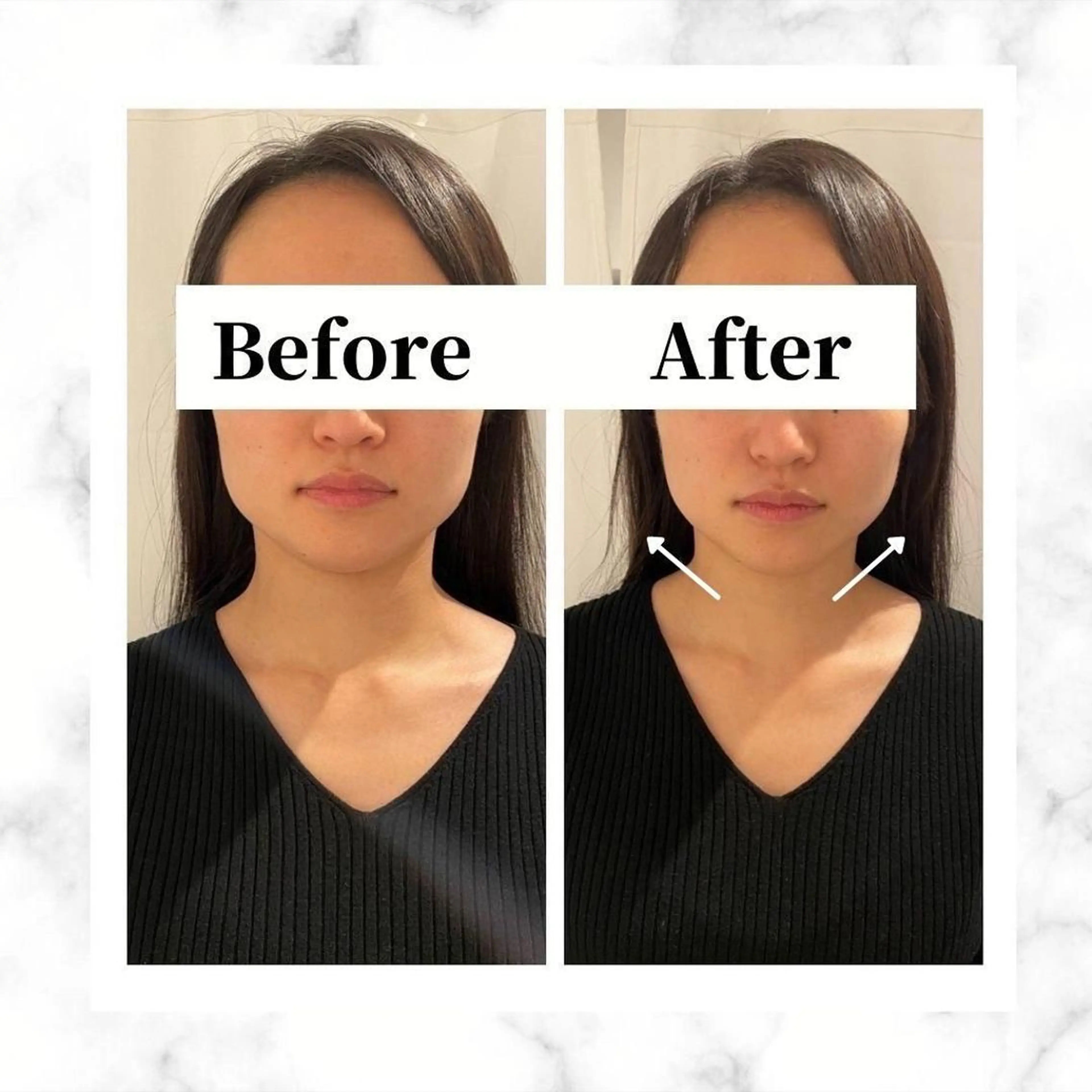 12Dハイフ💗 最強小顔のエステ・リラクイメージ