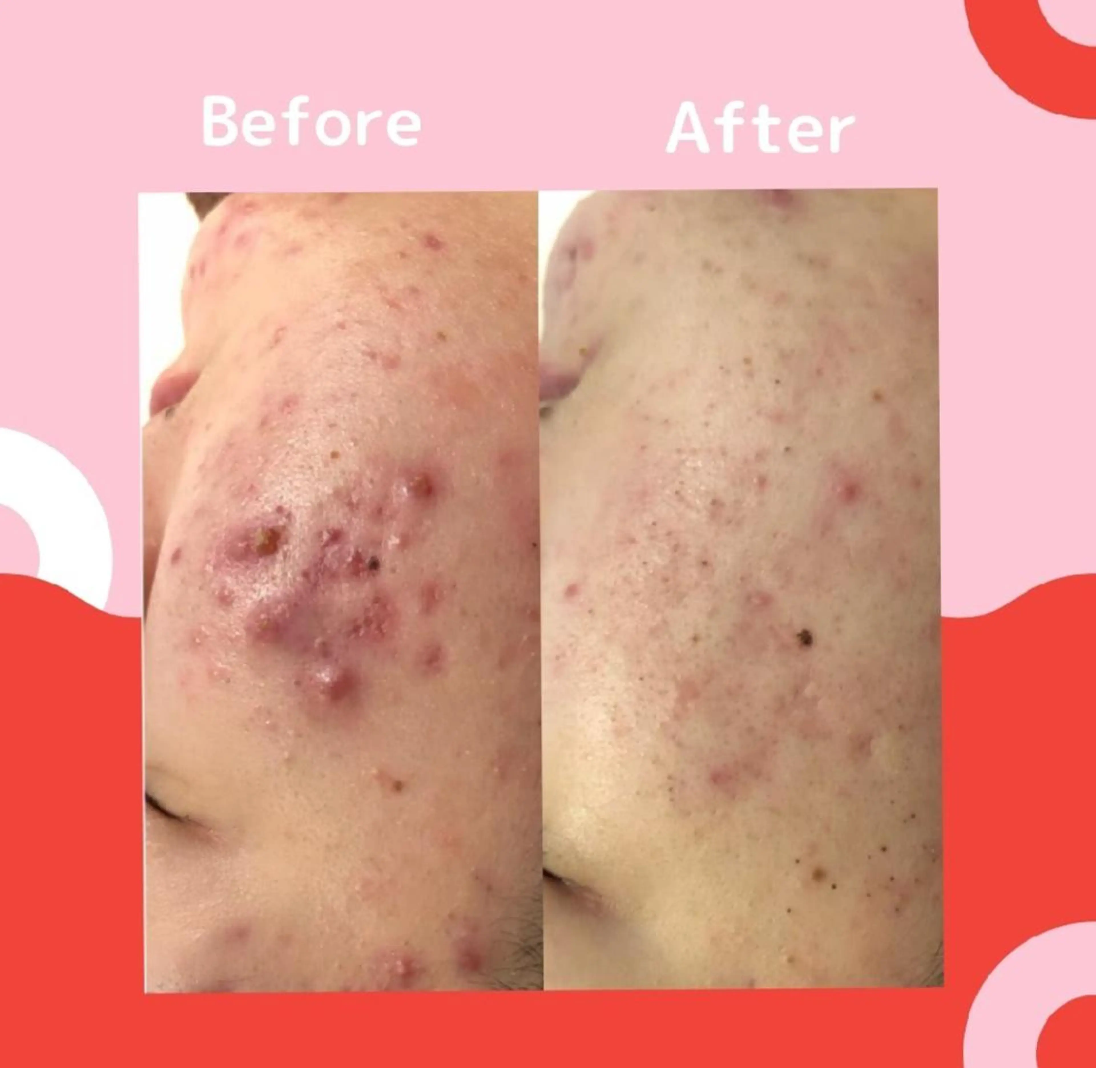 3か月で肌革命👼 ニキビ専門店💫のエステ・リラクイメージ