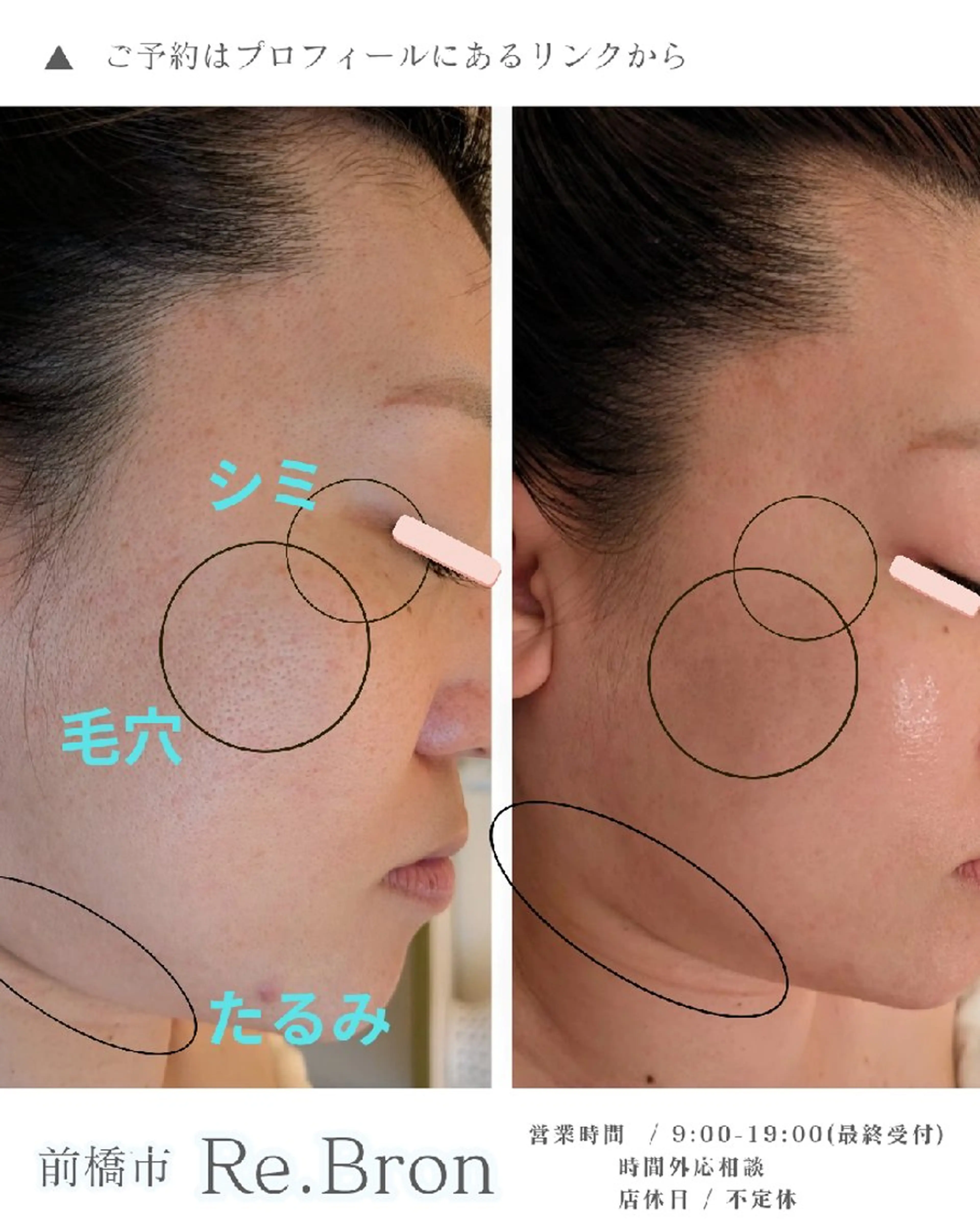 エステ リラク 毛穴ケア くすみ肌 ハーブピーリングのエステ・リラクイメージ