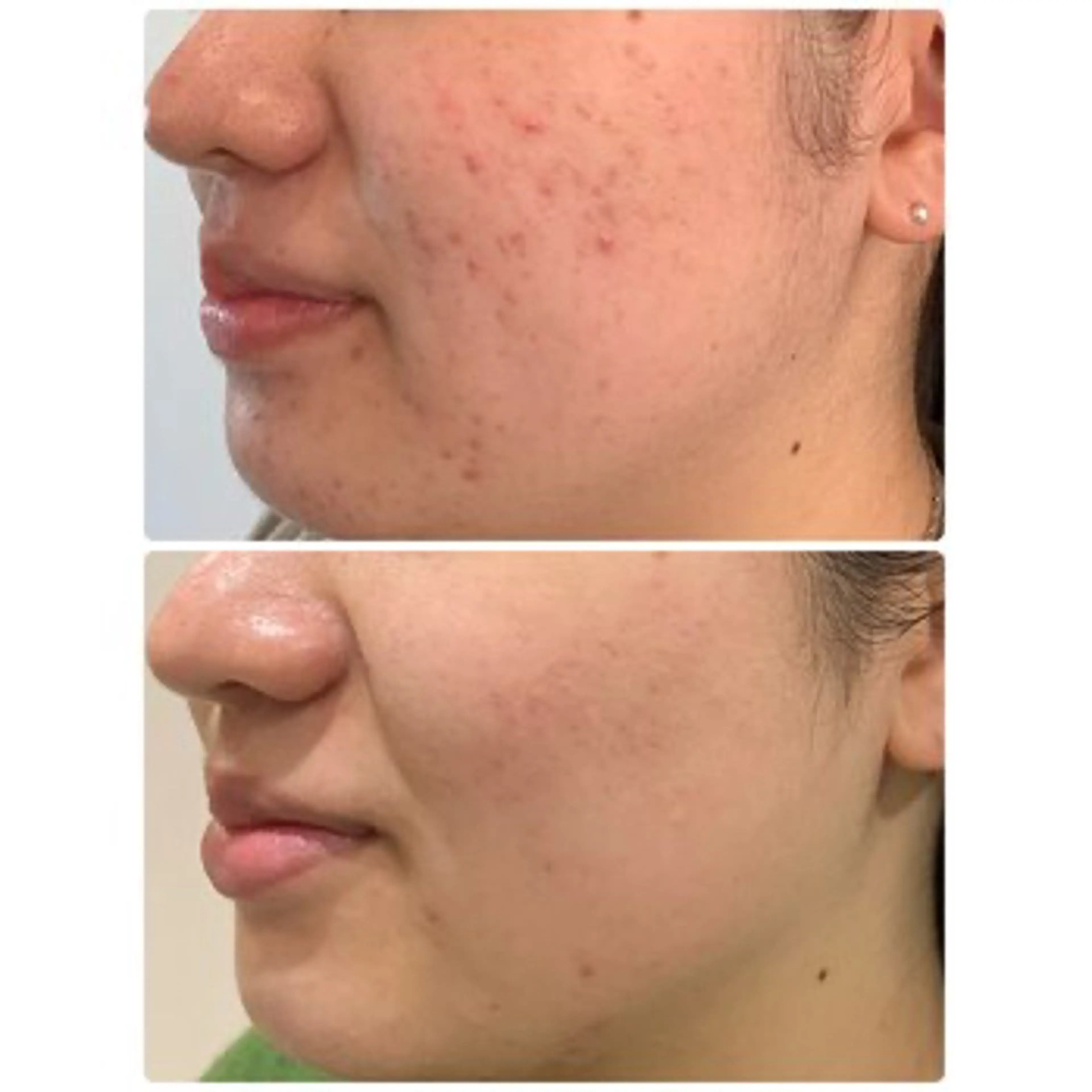 ハイドラフェイシャル☆毛穴洗浄☆＋悩み別耳つぼジュエリー付きの写真