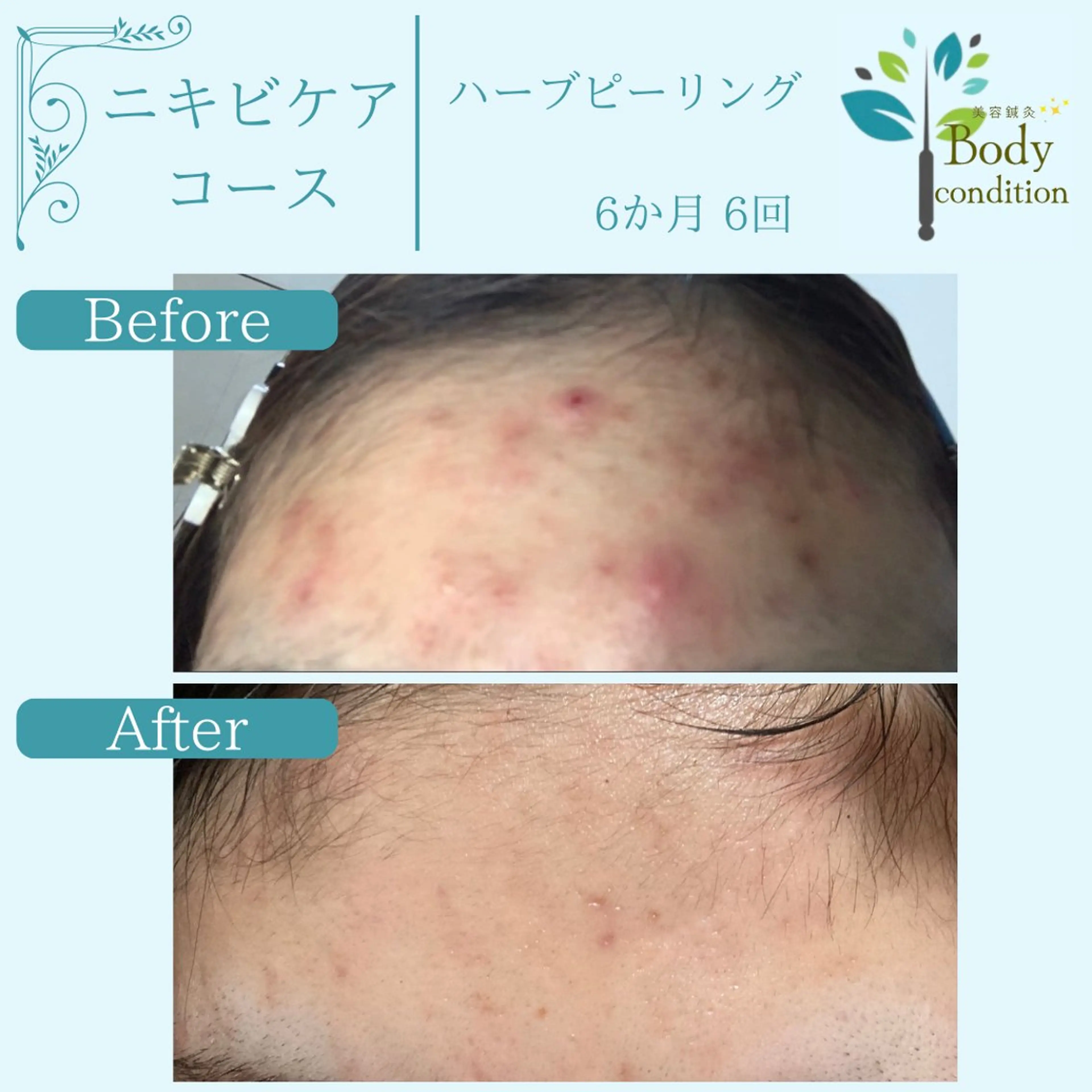 小顔ハーブピーリング 美容鍼/毛穴洗浄のエステ・リラクイメージ