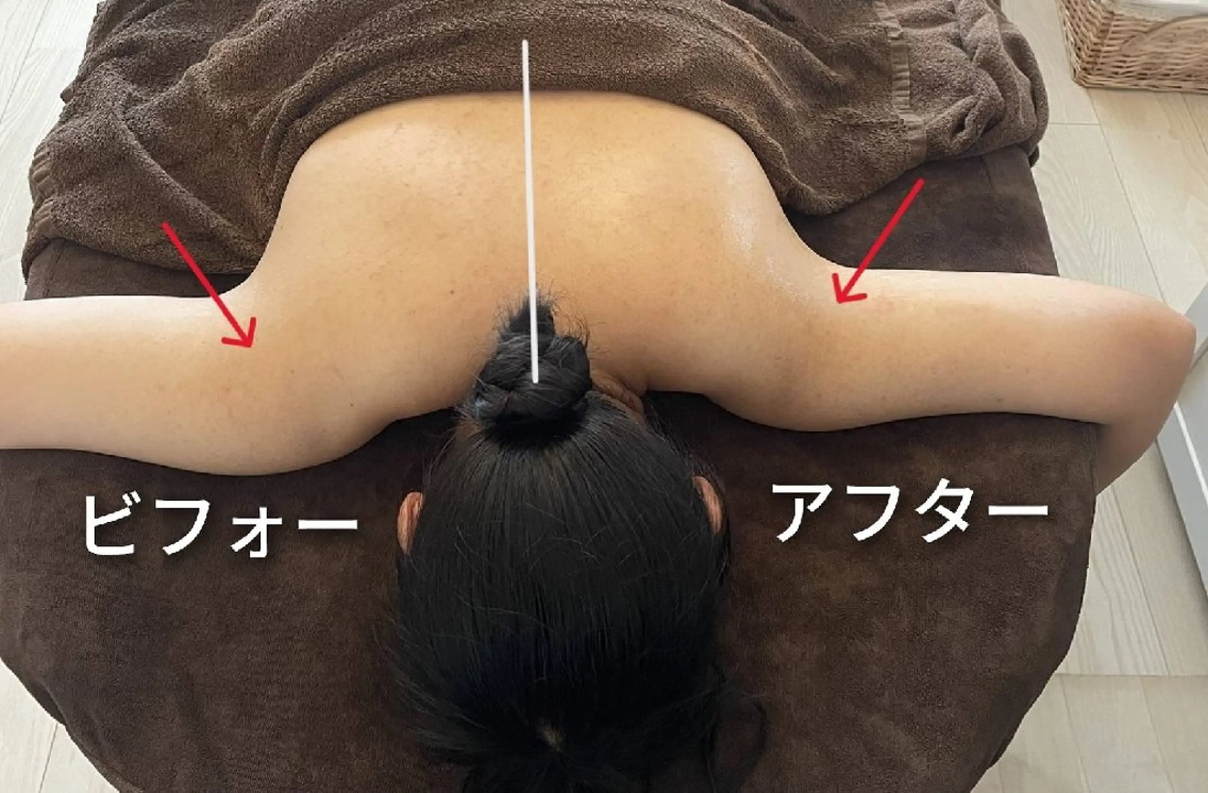 [切らない脂肪吸引]ほっそり二の腕美人の写真