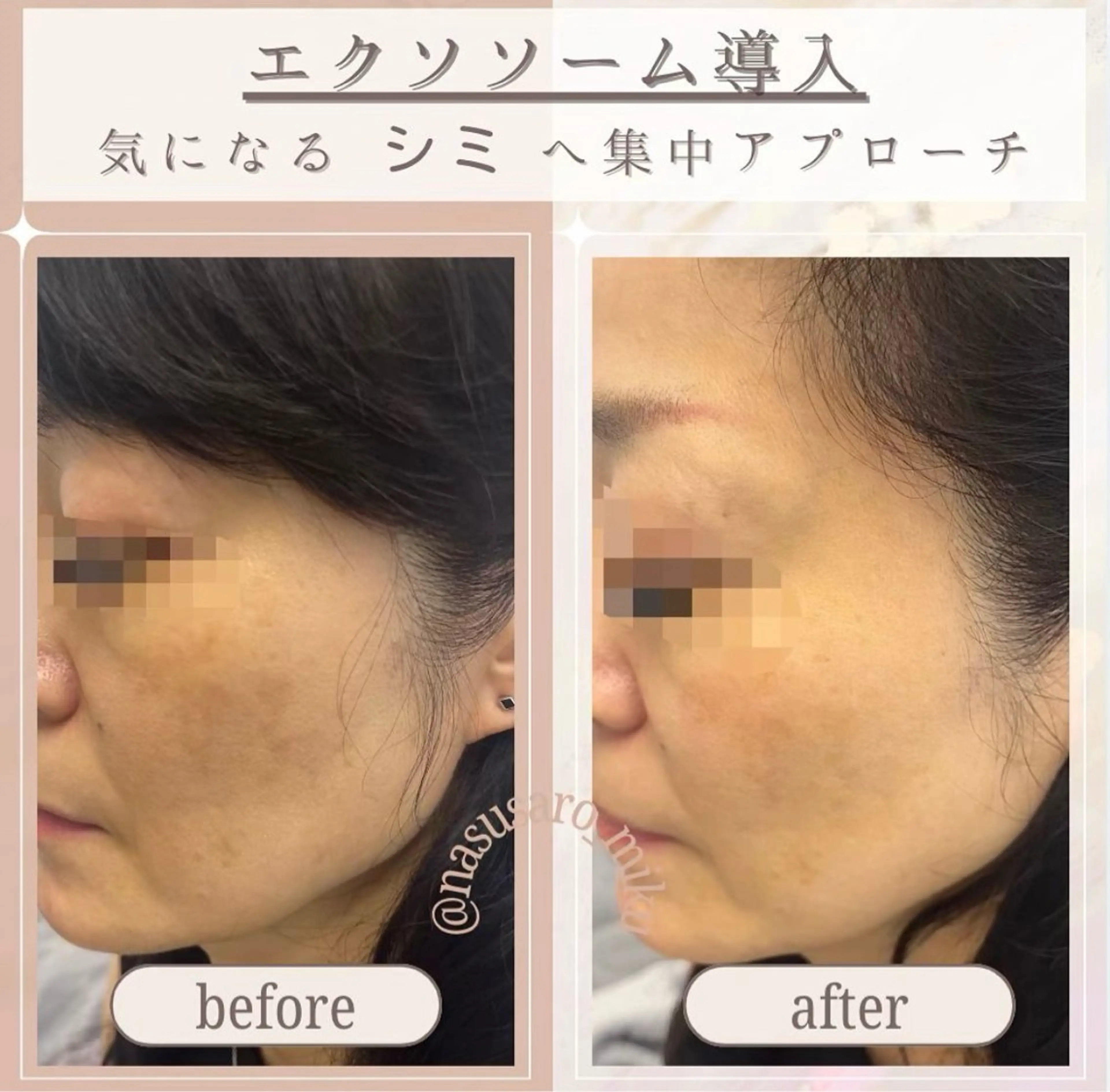 🎀韓国式肌改善🎀 Miku🇰🇷💎のエステ・リラクイメージ