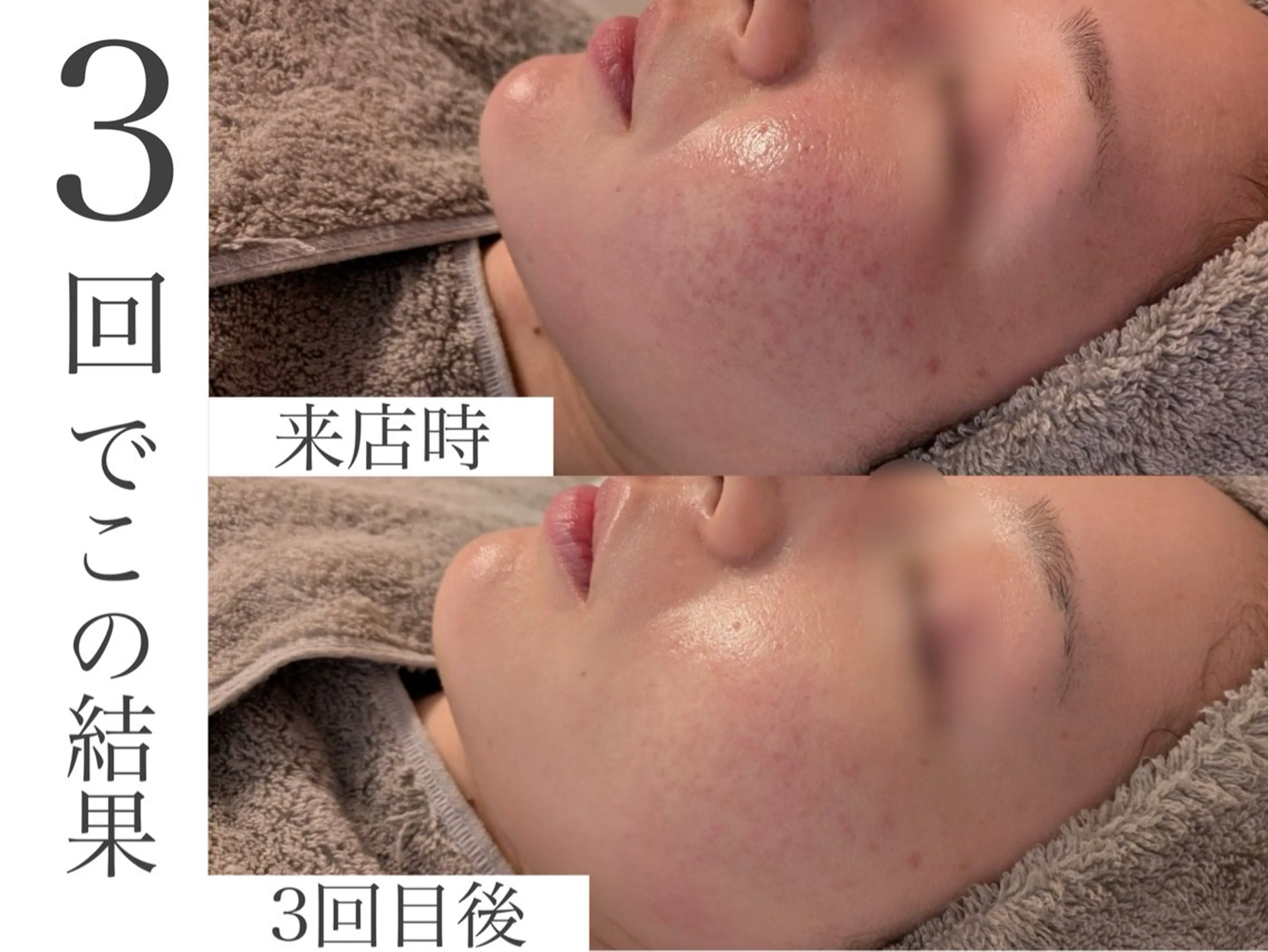 ≪肌質改善施術が初めての方、乾燥肌・敏感肌向け》の写真