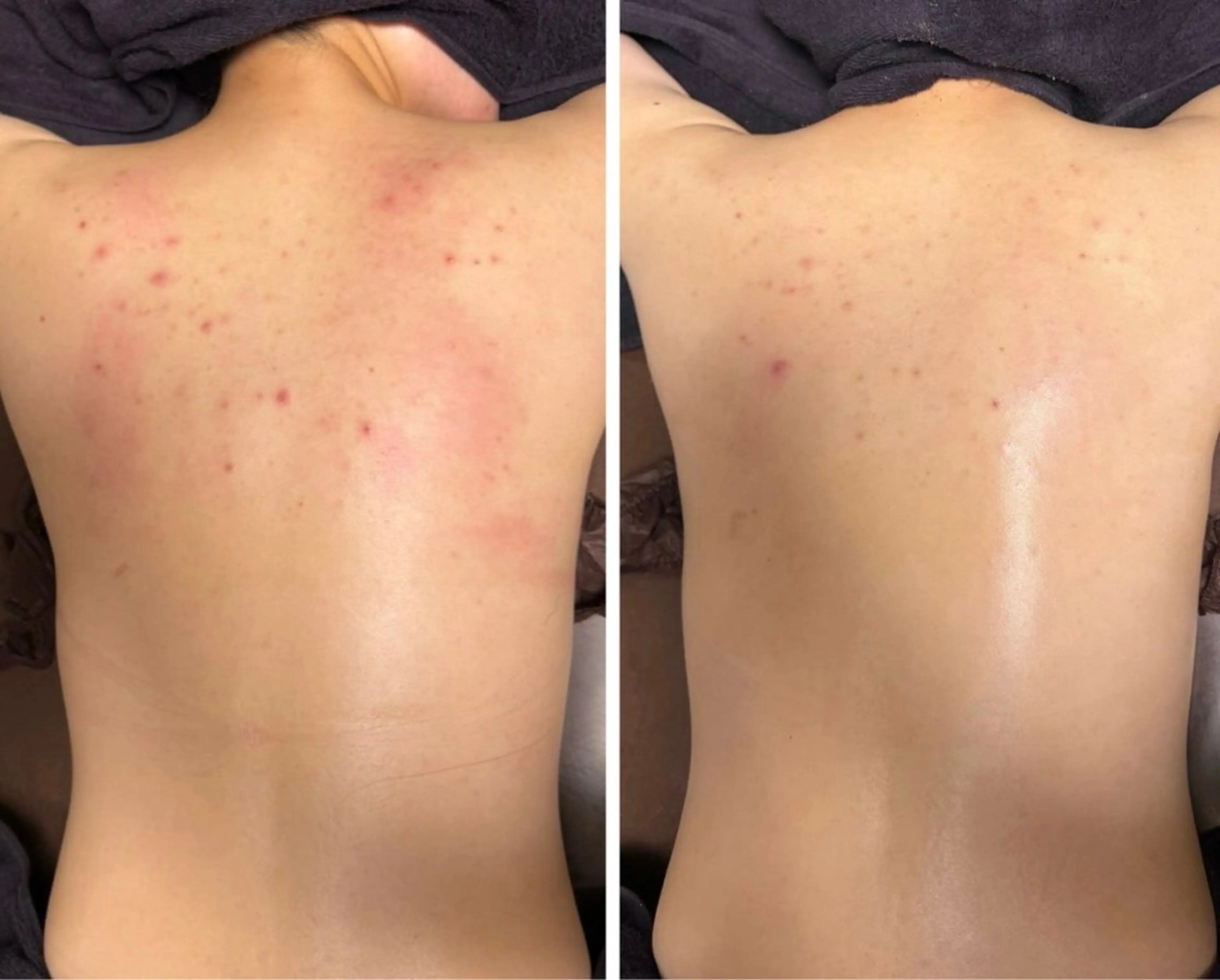 【背中荒れ・痩身】陶肌トリートメント【背中上部】¥8,800(陶肌パウダー1ｇプレゼント)の写真