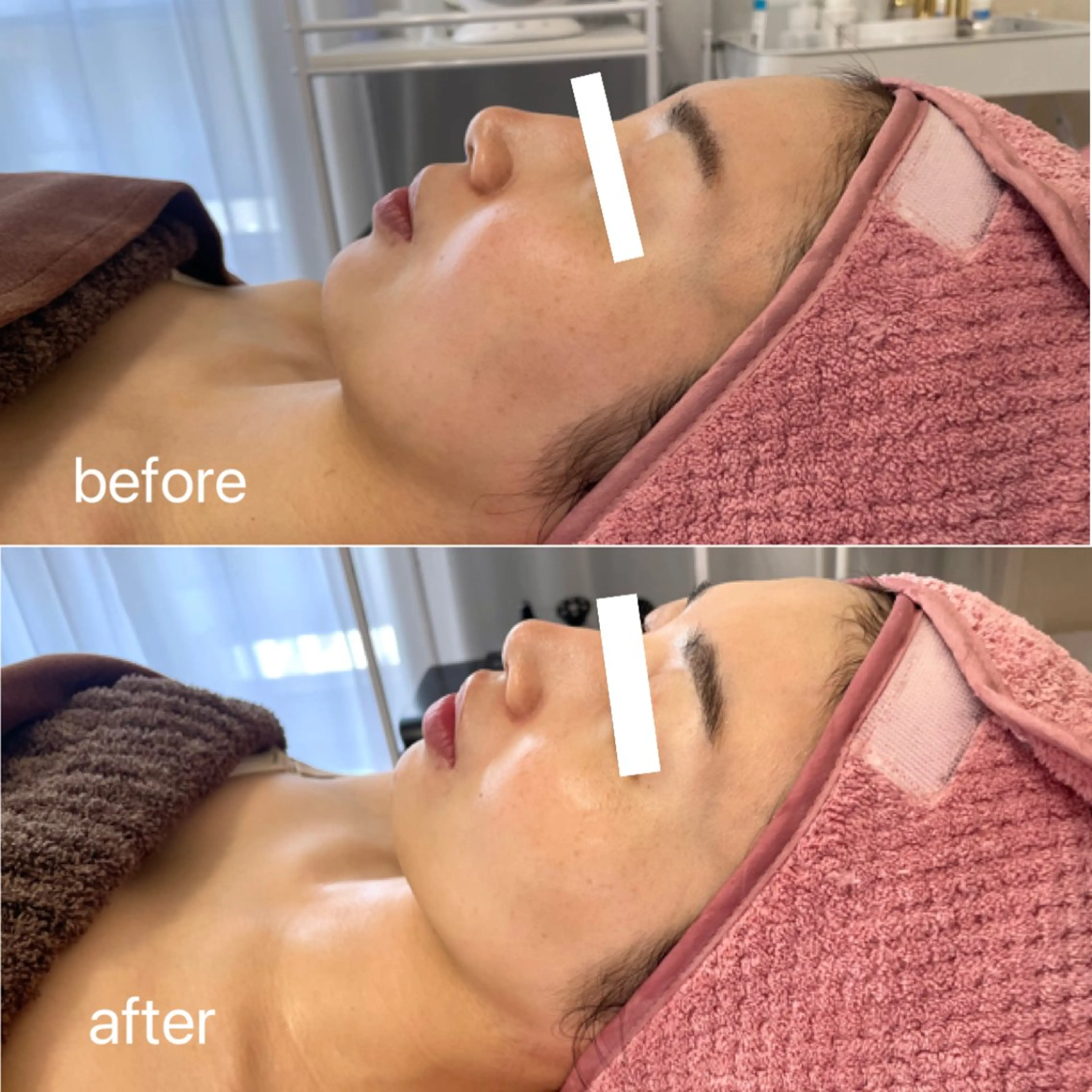 【ツヤ肌・潤い肌】大人気ララピール+エレクトロポレーション美容液導入SETの写真