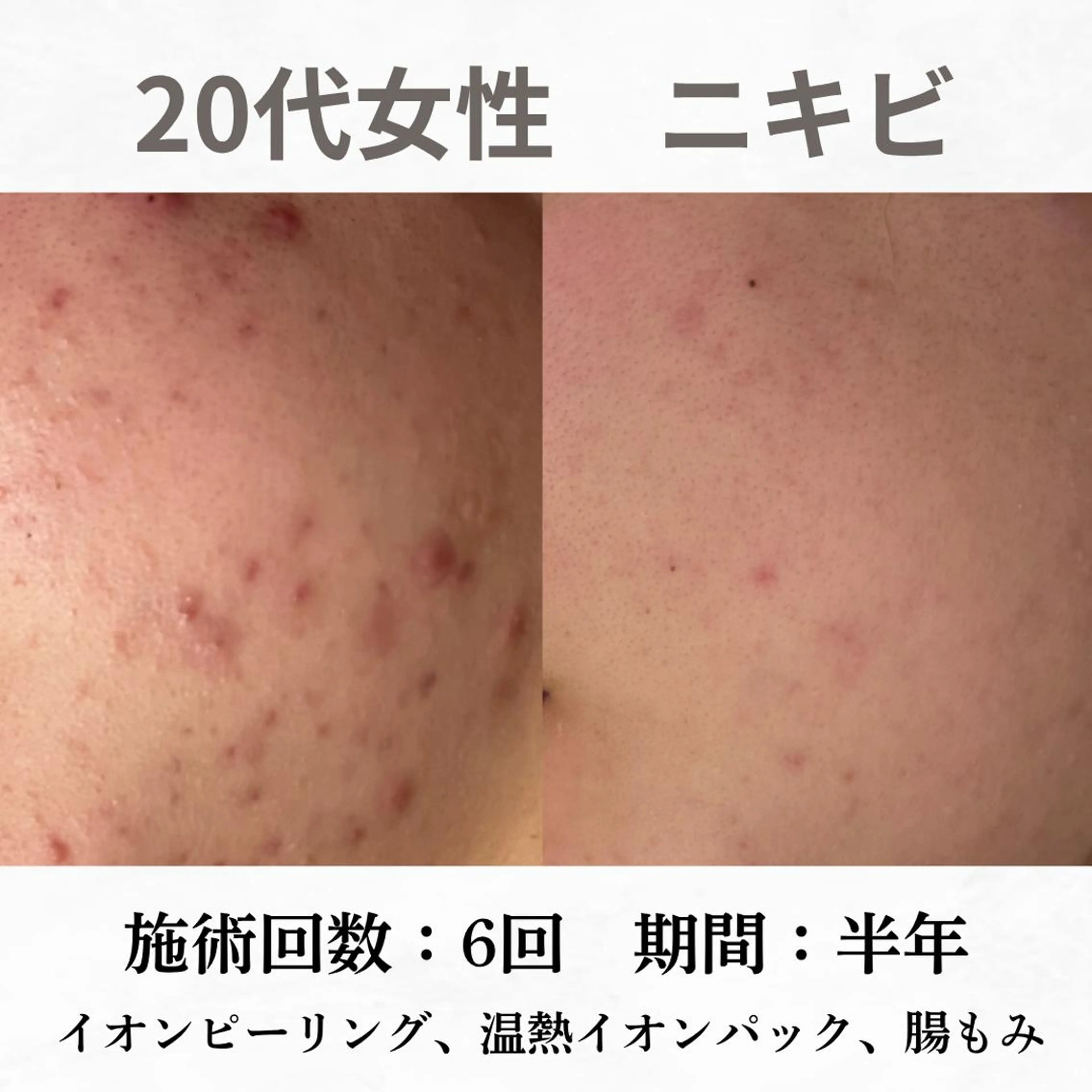 重度ニキビ専門🌷 ダウンタイムなしのエステ・リラクイメージ