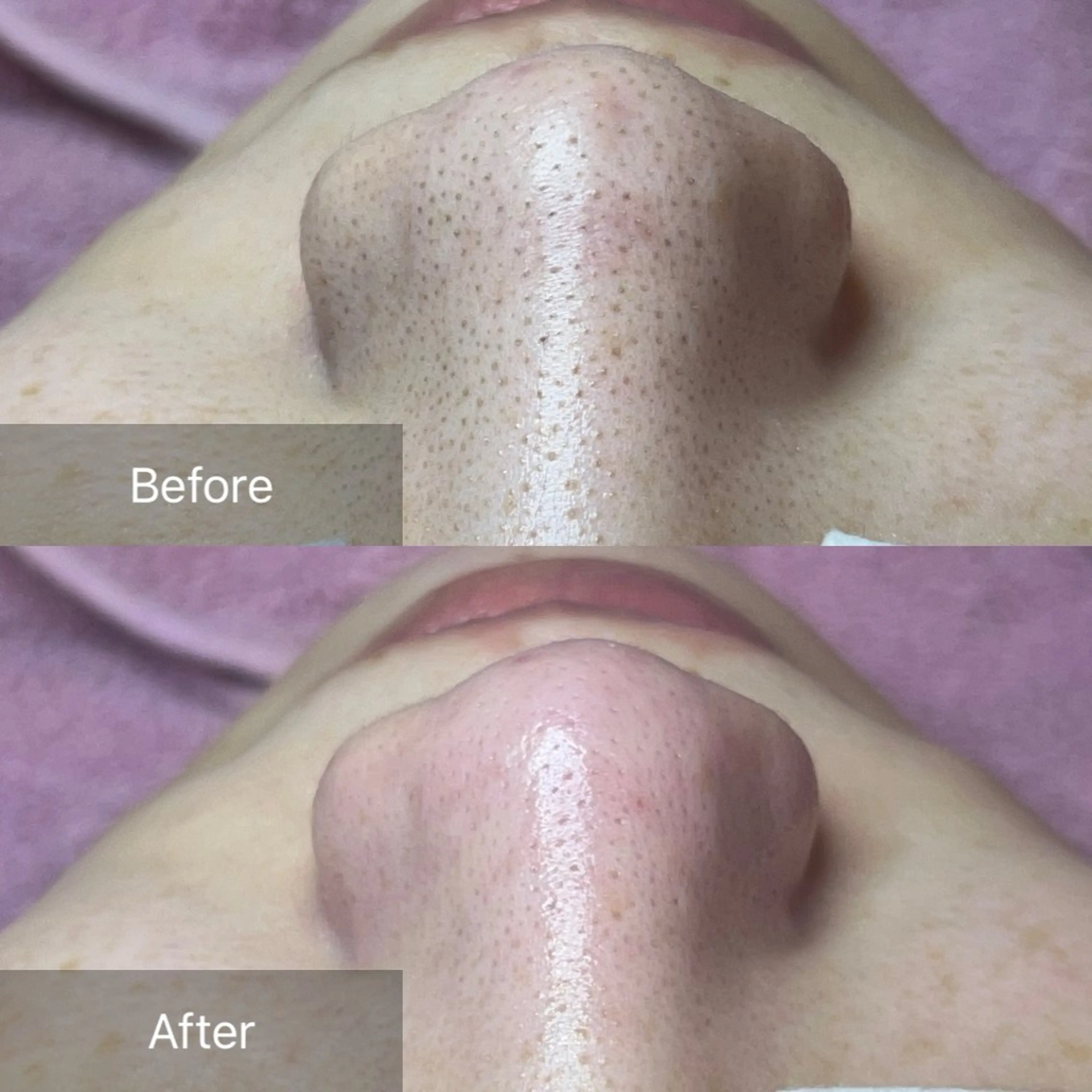 エステ ielu〜毛穴ケア ハーブピーリングのエステ・リラクイメージ