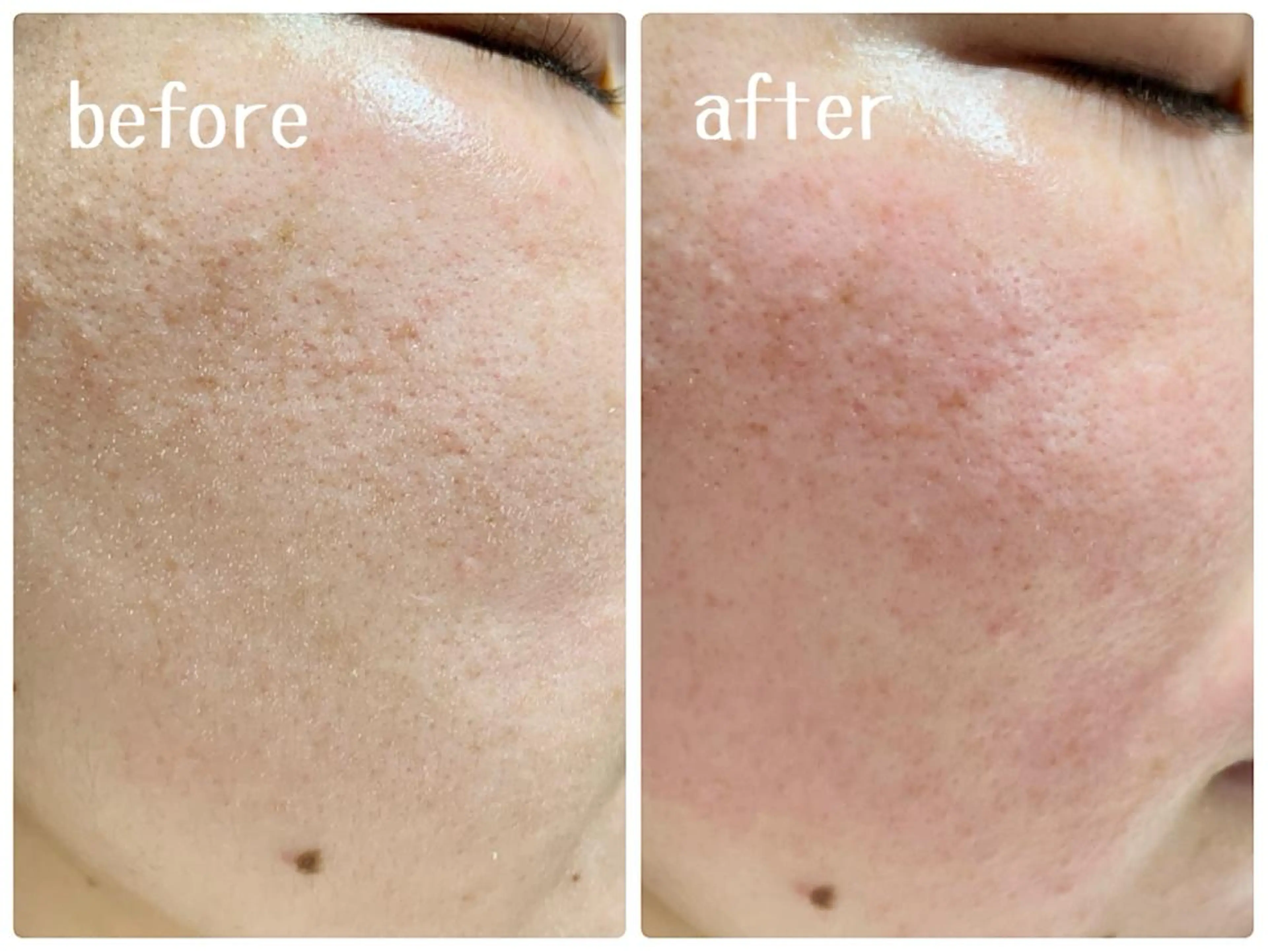 【新規】部分フェイスワックス（おでこ、頬、口周り、鼻）から1つ選択＋眉毛ワックス🌟人気のセットメニュー✨の写真