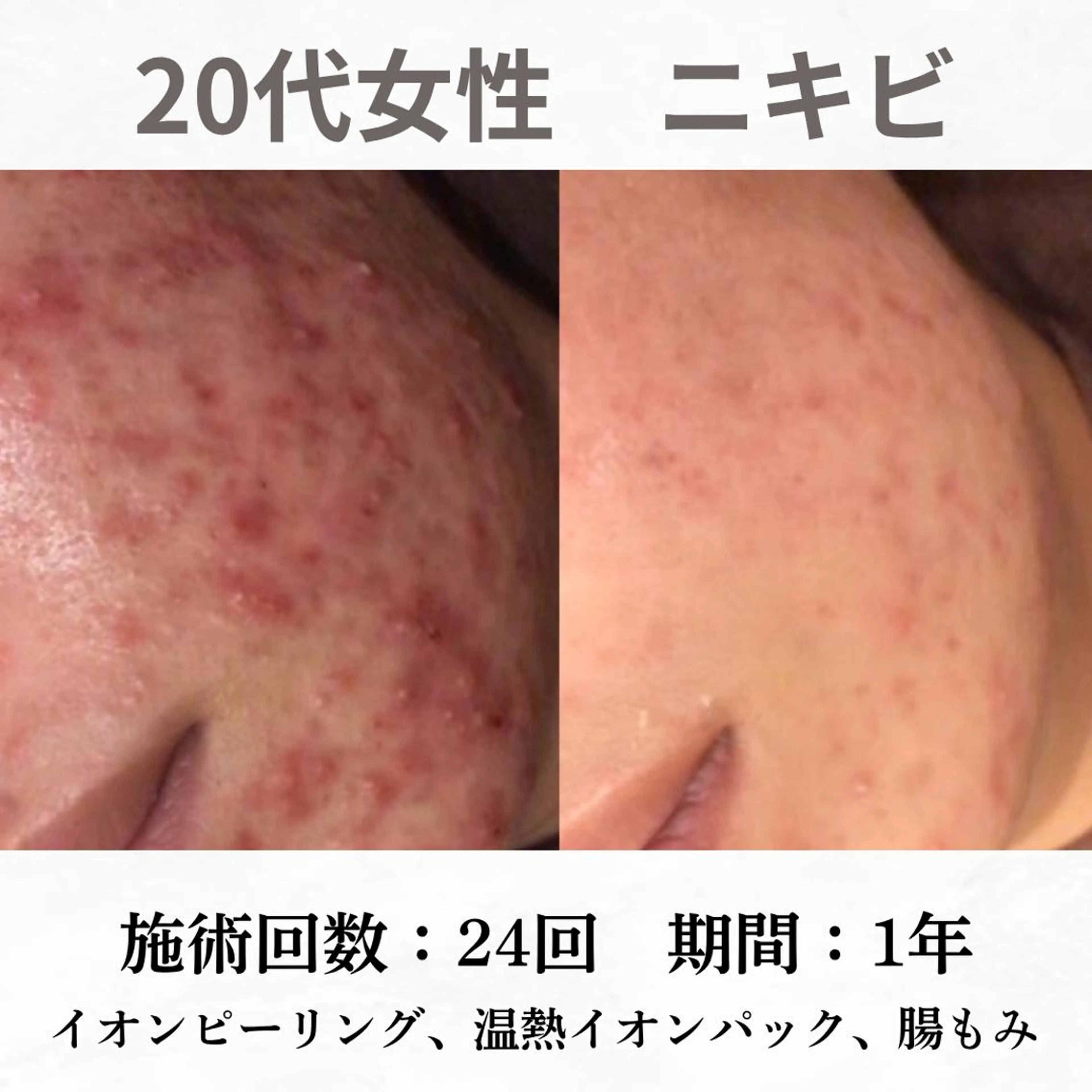 重度ニキビ専門🌷 ダウンタイムなしのエステ・リラクイメージ