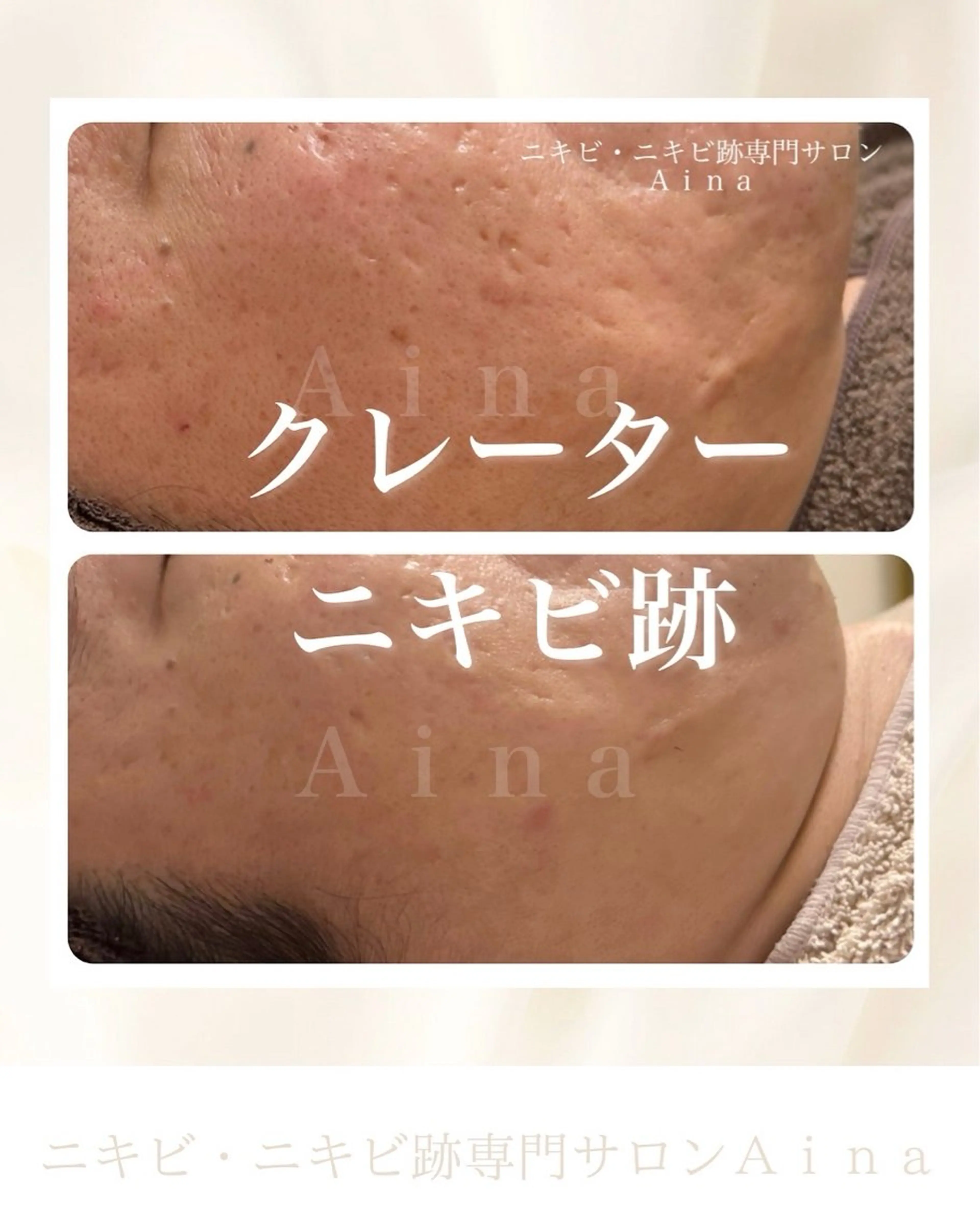 エステ リラク ニキビ跡専門サロン Ａｉｎａのエステ・リラクイメージ