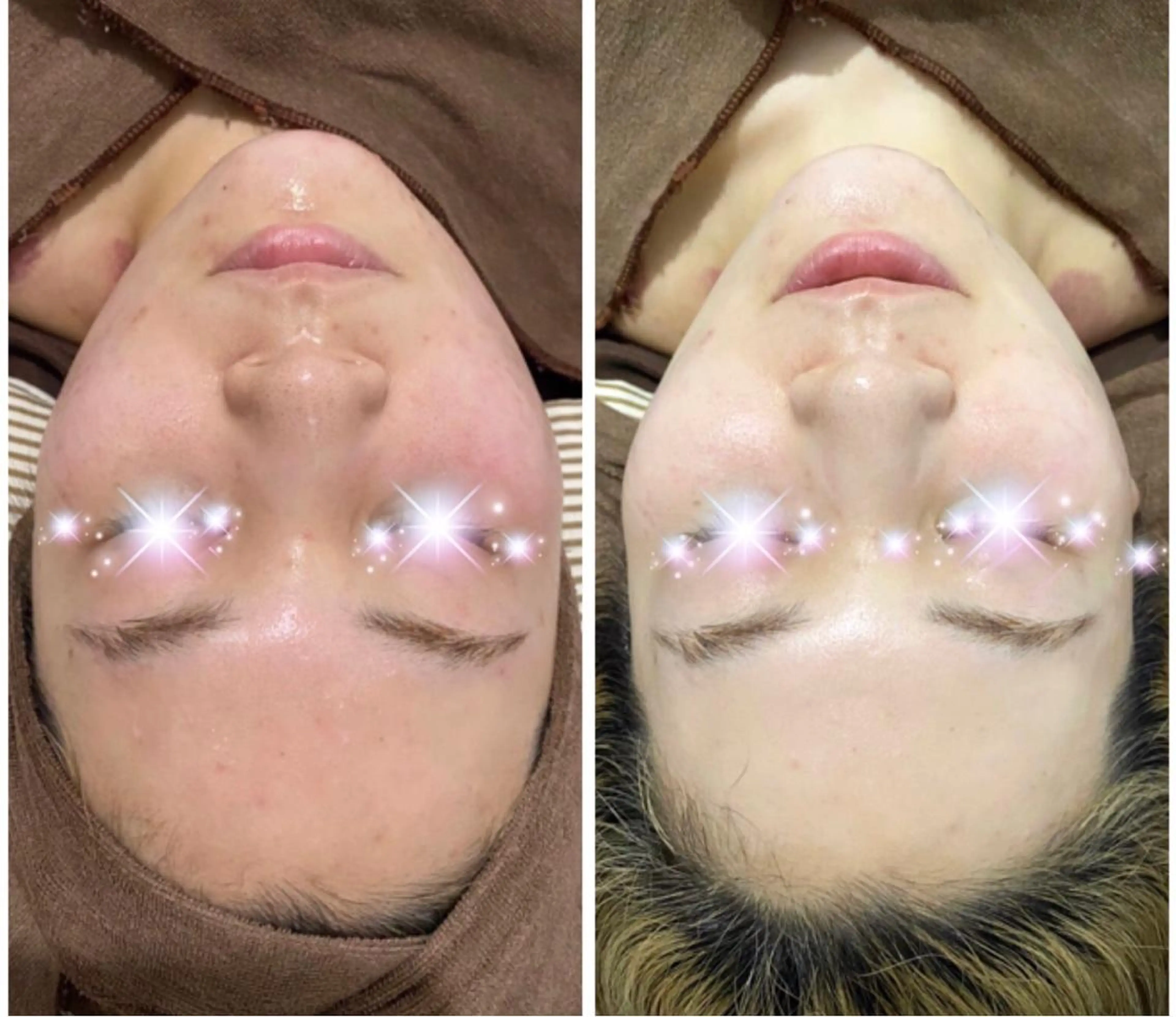 ハーブピーリング(剥離なし)の写真