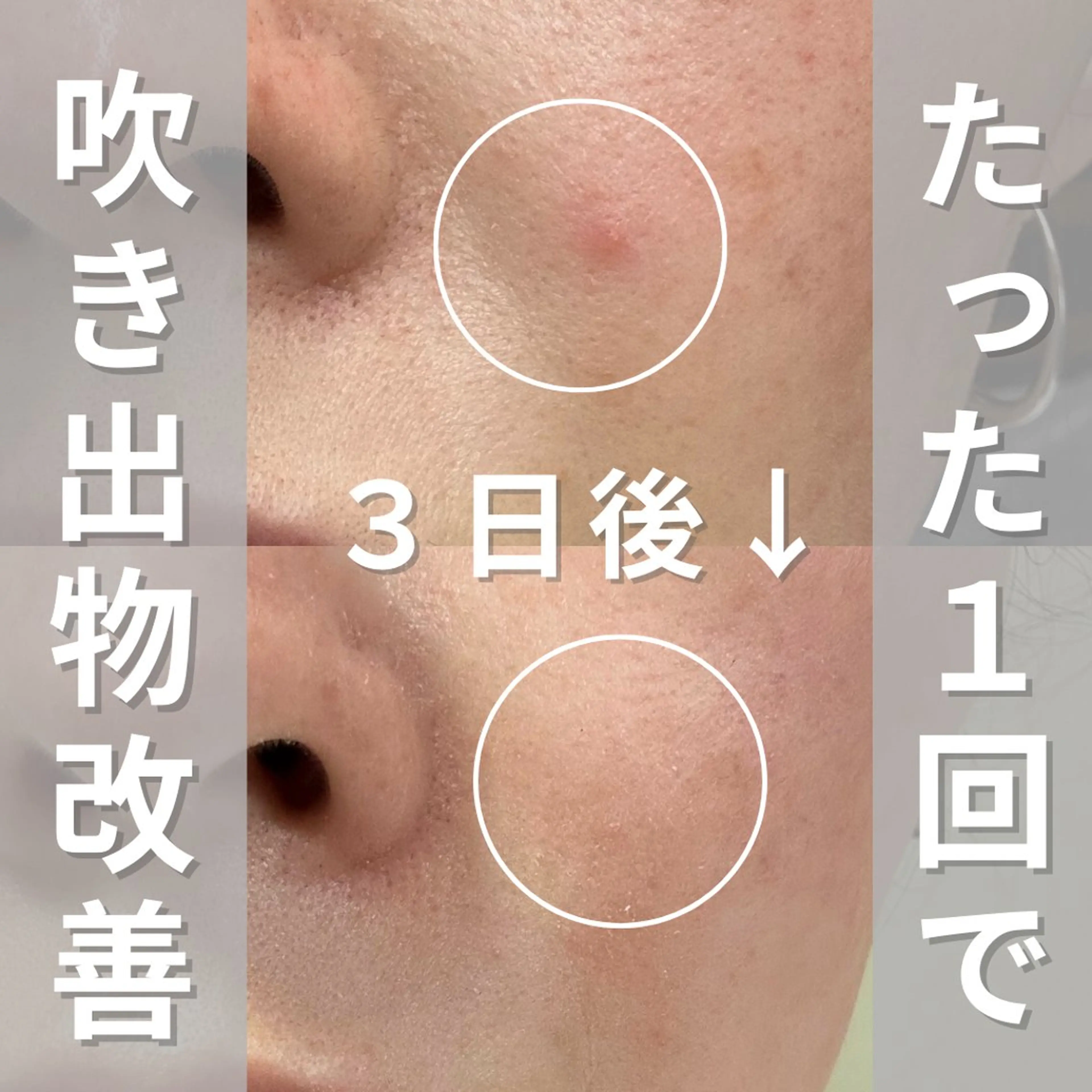 エステ ニキビ・ニキビ跡改善 leoloのエステ・リラクイメージ