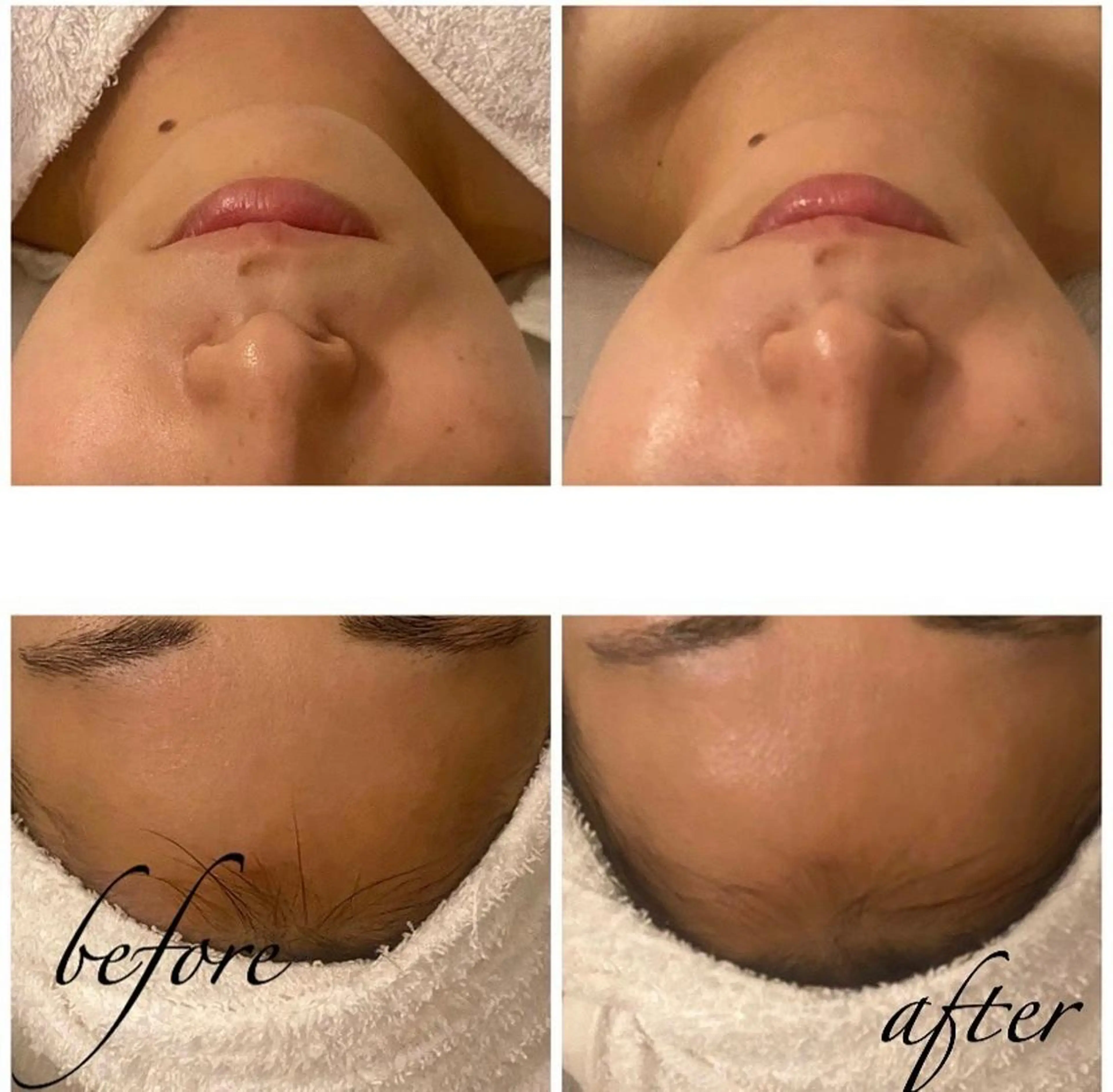 エステ 韓国/ピーリング 毛穴洗浄/POLAのエステ・リラクイメージ