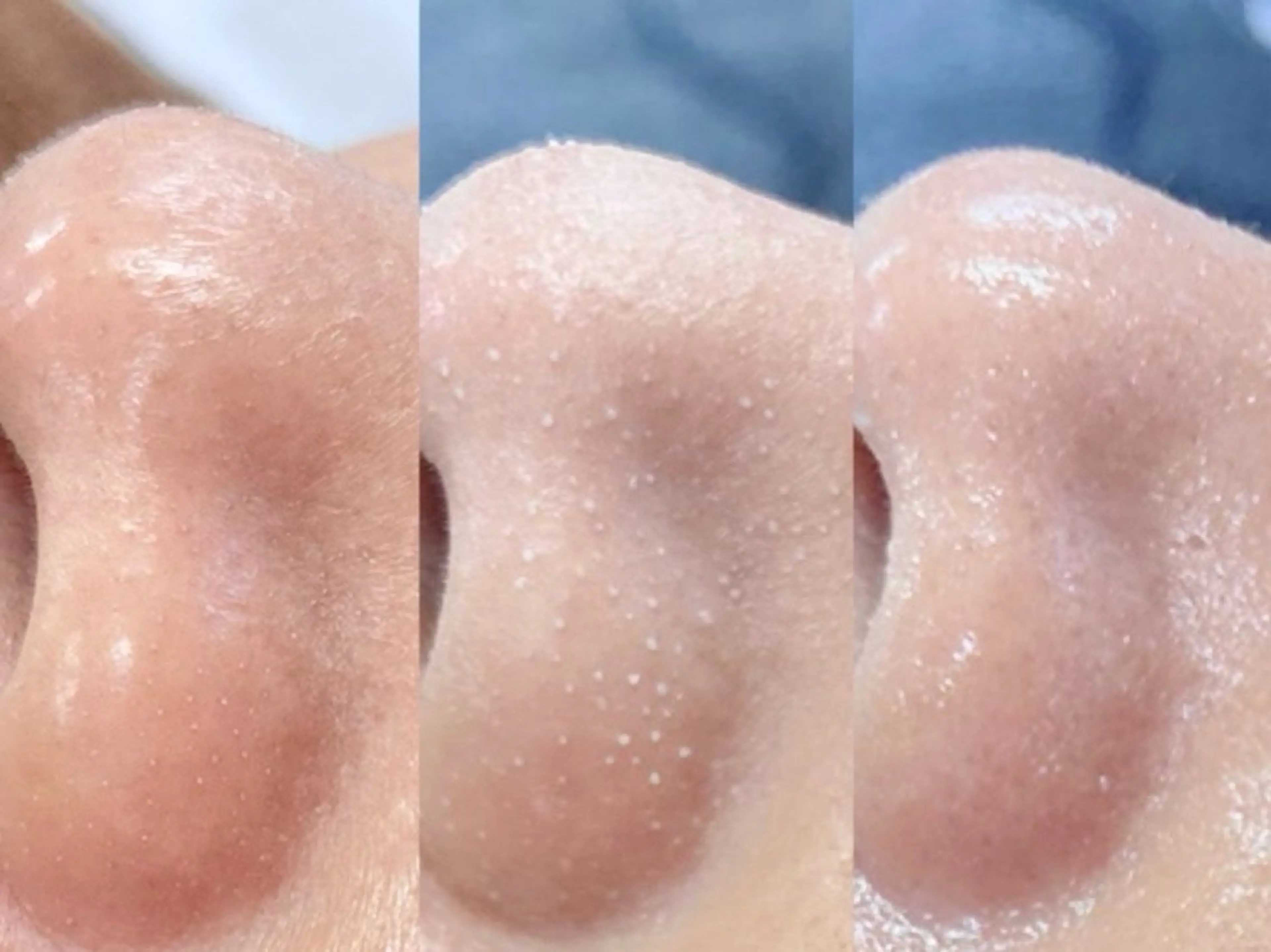 【毛穴洗浄】ハイドロディープクレンジング/小鼻の黒ずみ集中ケアの写真