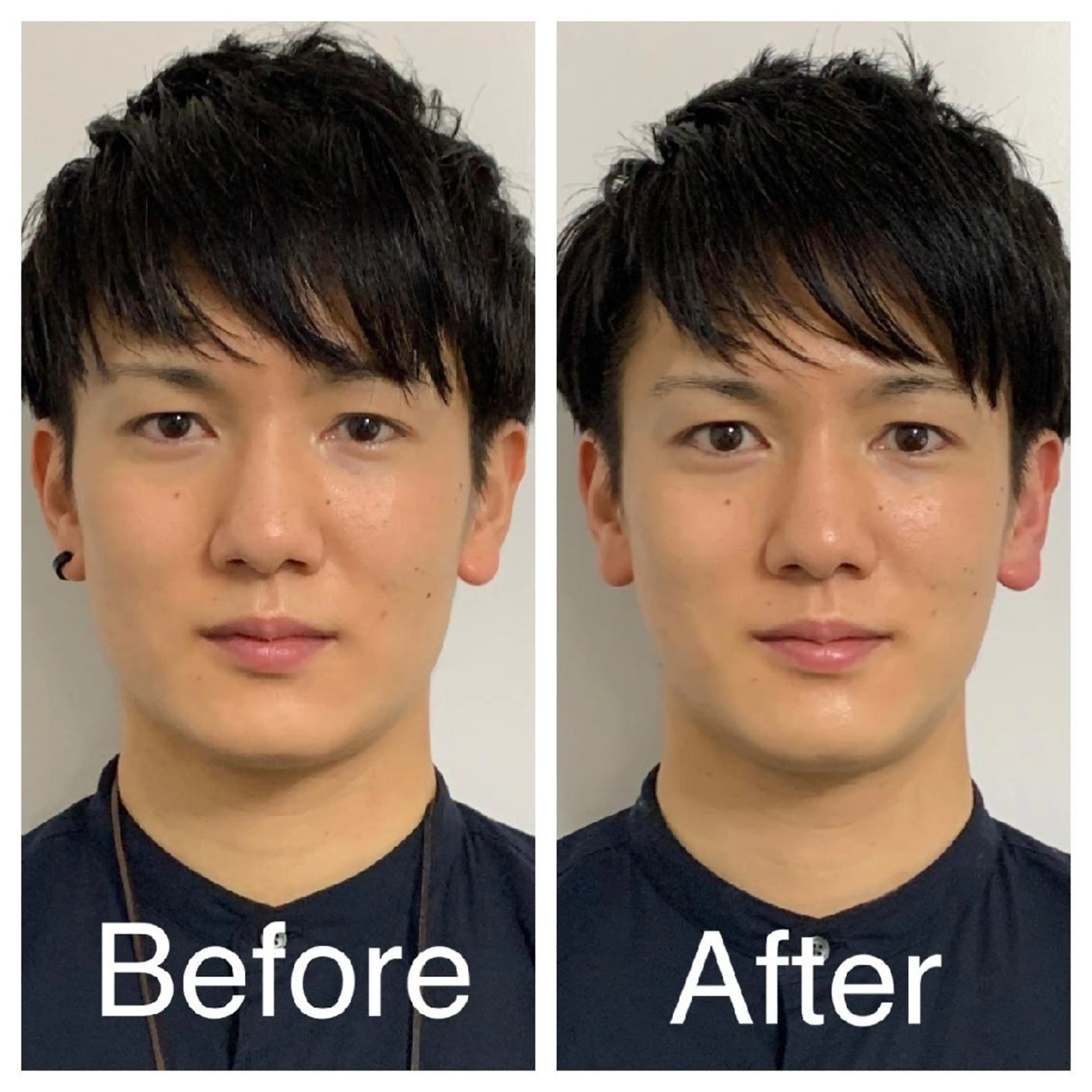 メンズ 医療提携Ruby所属・医療提携Ruby小顔 ハーブピーリングのその他イメージ