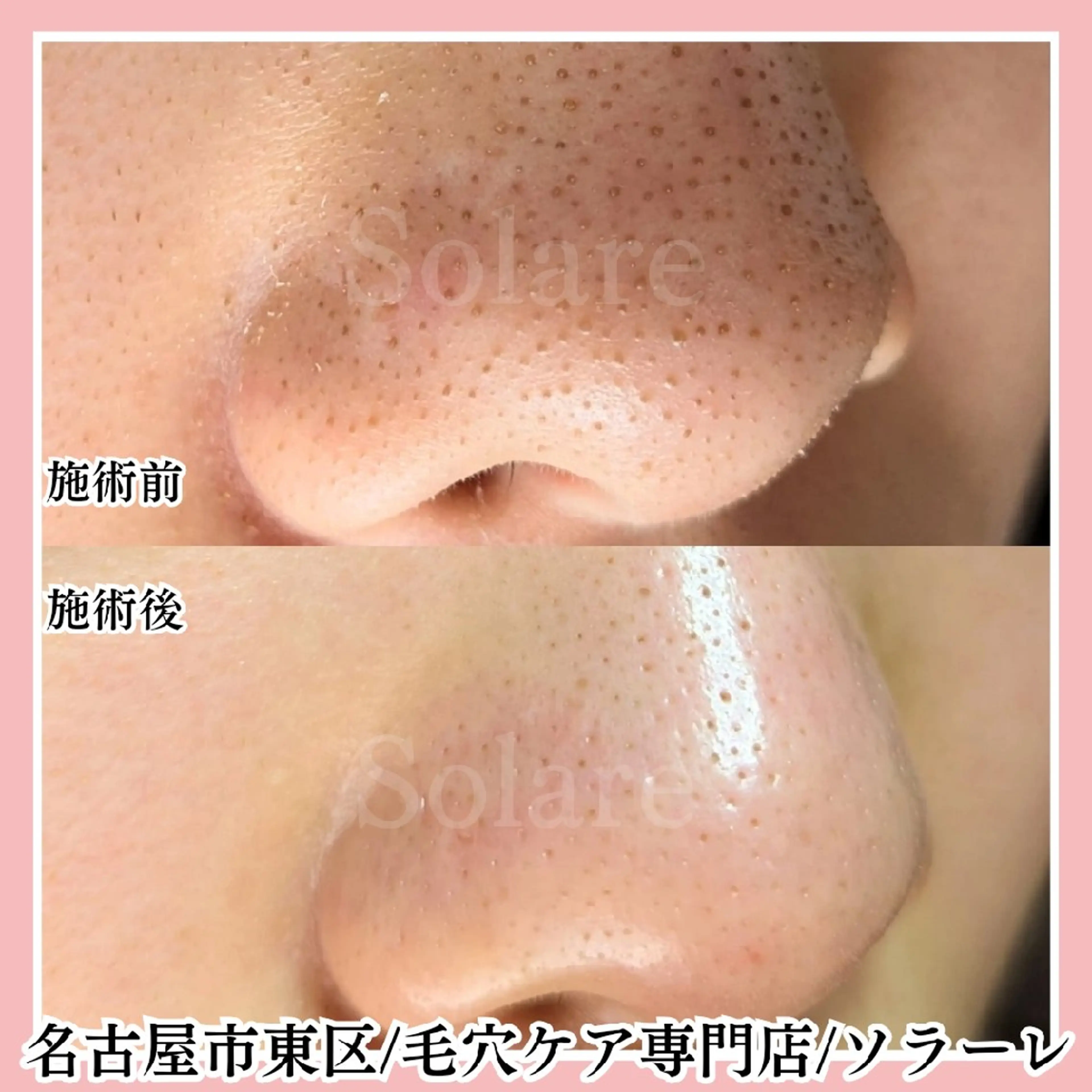 毛穴の汚れを根こそぎ洗浄＋フェイシャル＆デコルテマッサージの写真