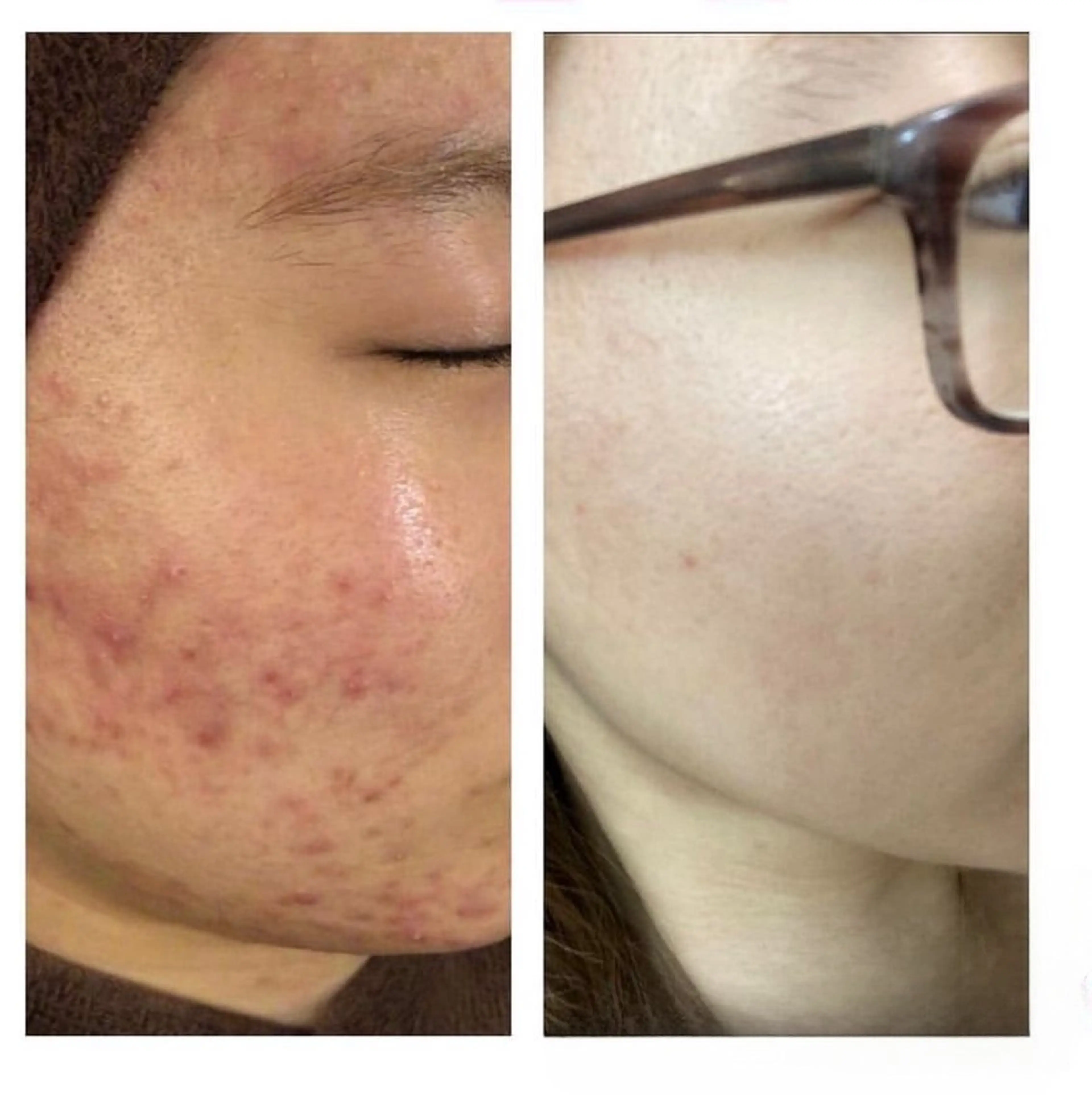 金の糸脱毛 産毛ケア専門のエステ・リラクイメージ