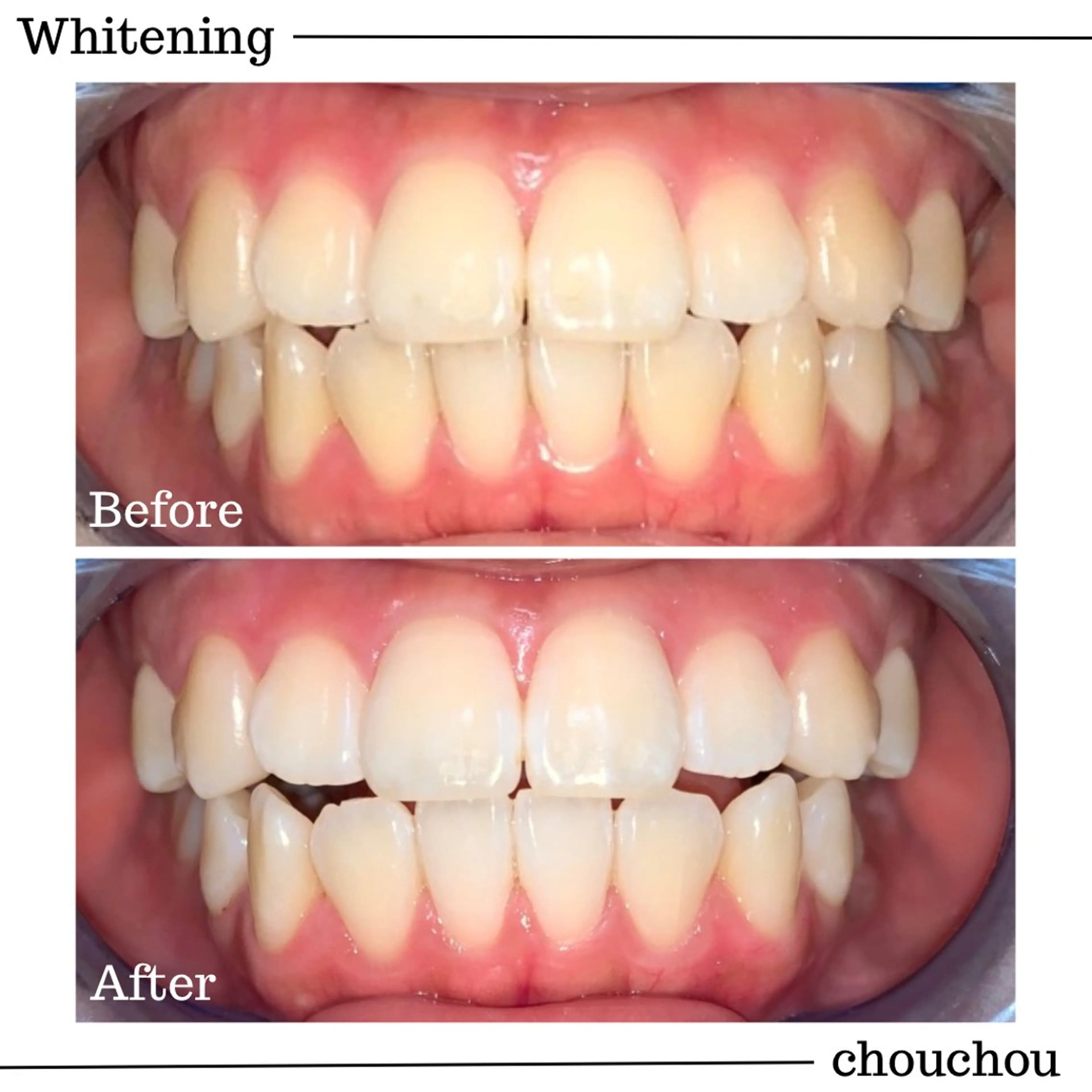 【初回限定】クリーニングジェルホワイトニング 3照射の写真