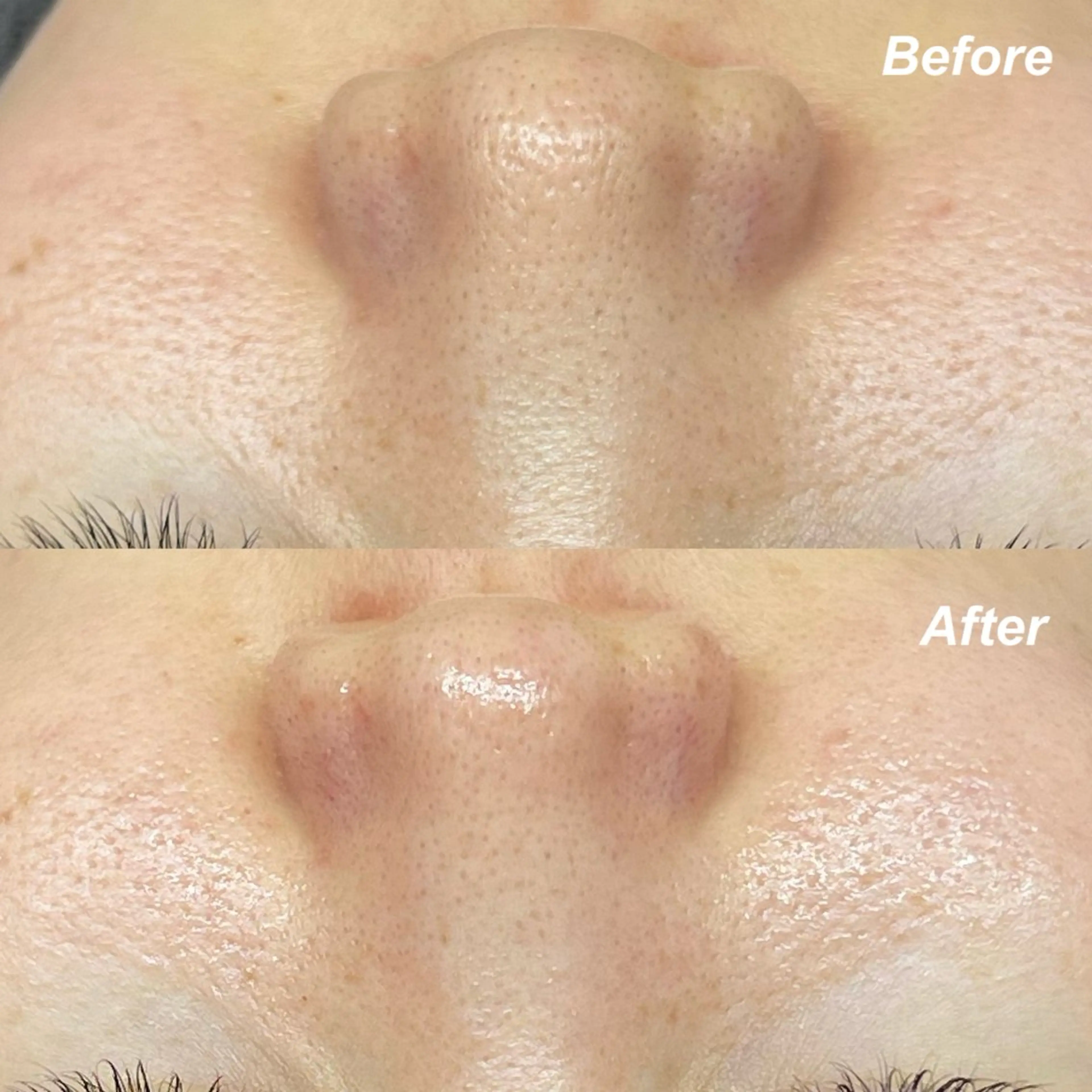 【第四世代ピーリング🇰🇷+毛穴洗浄】の写真