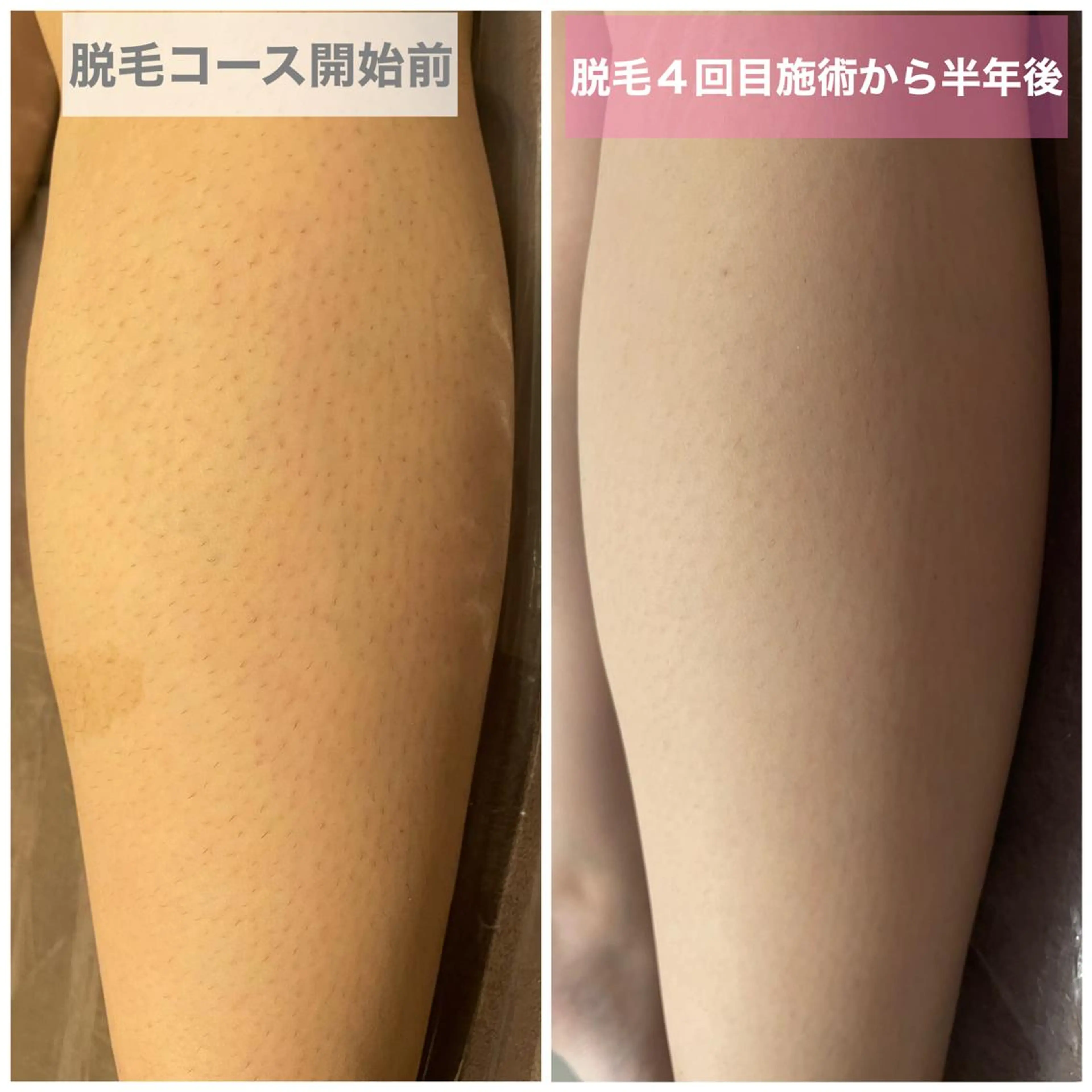 【18~29歳女性限定】ワキ脱毛1回の写真