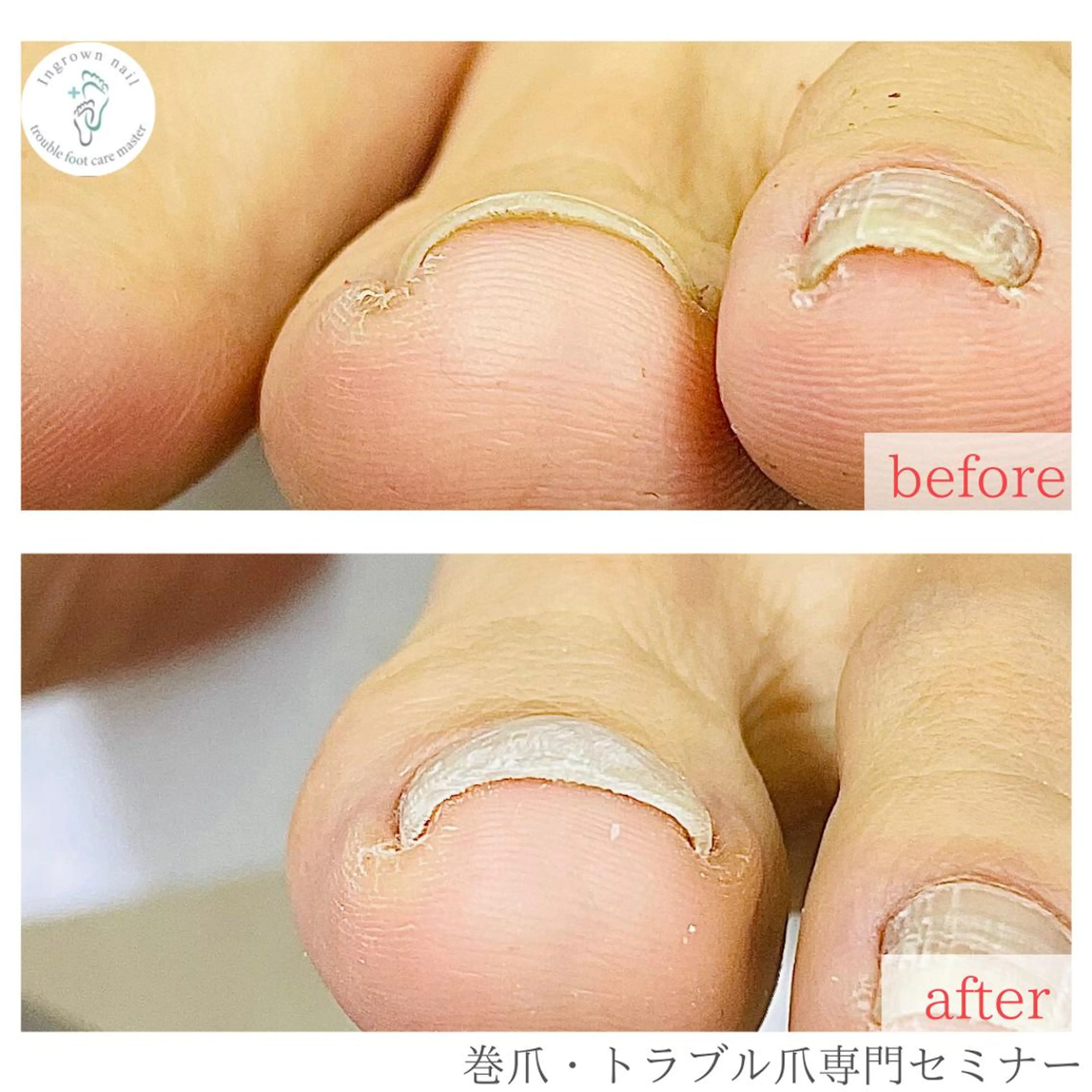 ネイル 深爪・巻き爪 専門サンセリテのネイルデザイン