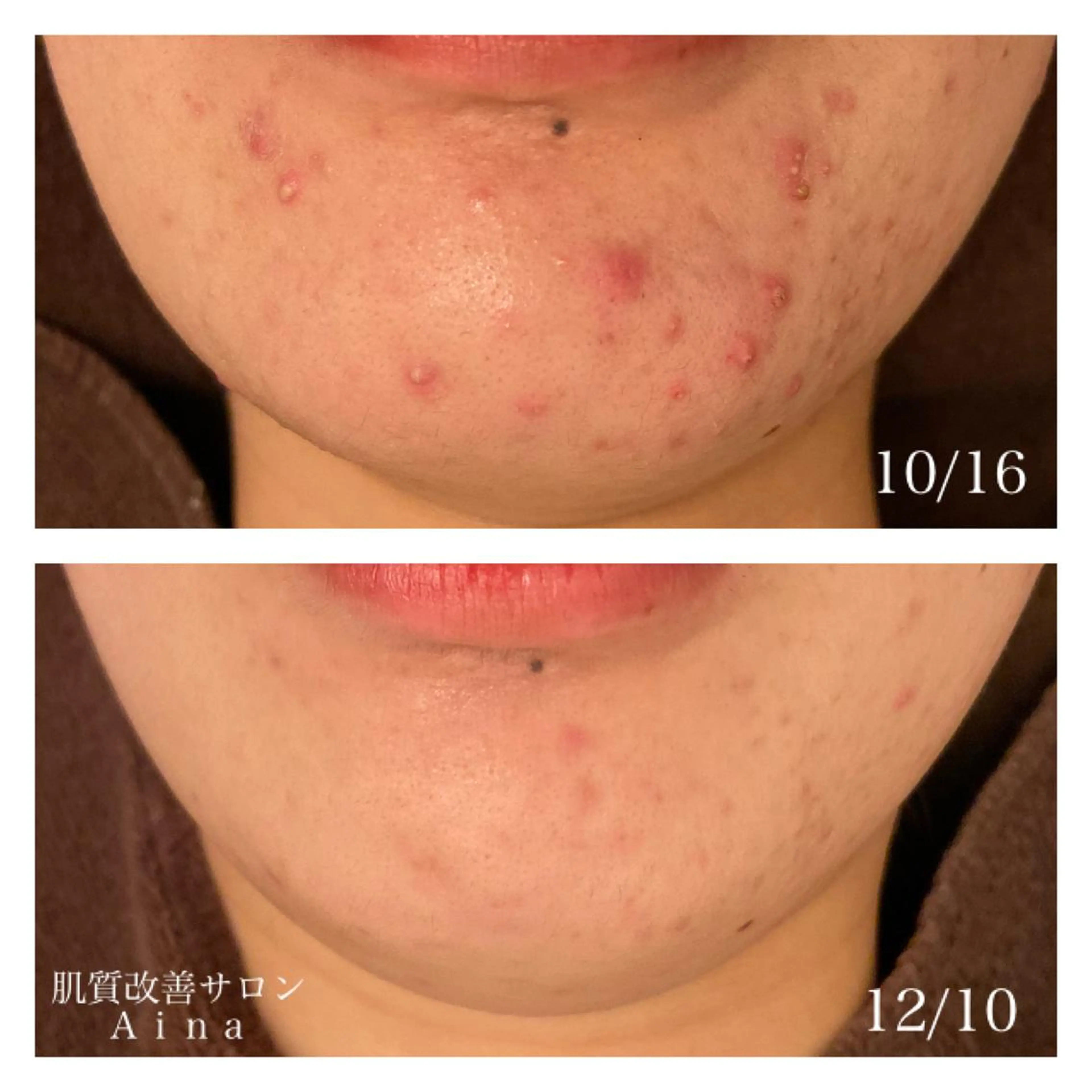 ミディアム カラー パーマ ヘアアレンジ メンズ キッズ ネイル マツエク・マツパ 卒業式のヘアスタイル 卒業式 エステ リラク ニキビ跡専門サロン Ａｉｎａのエステ・リラクイメージ