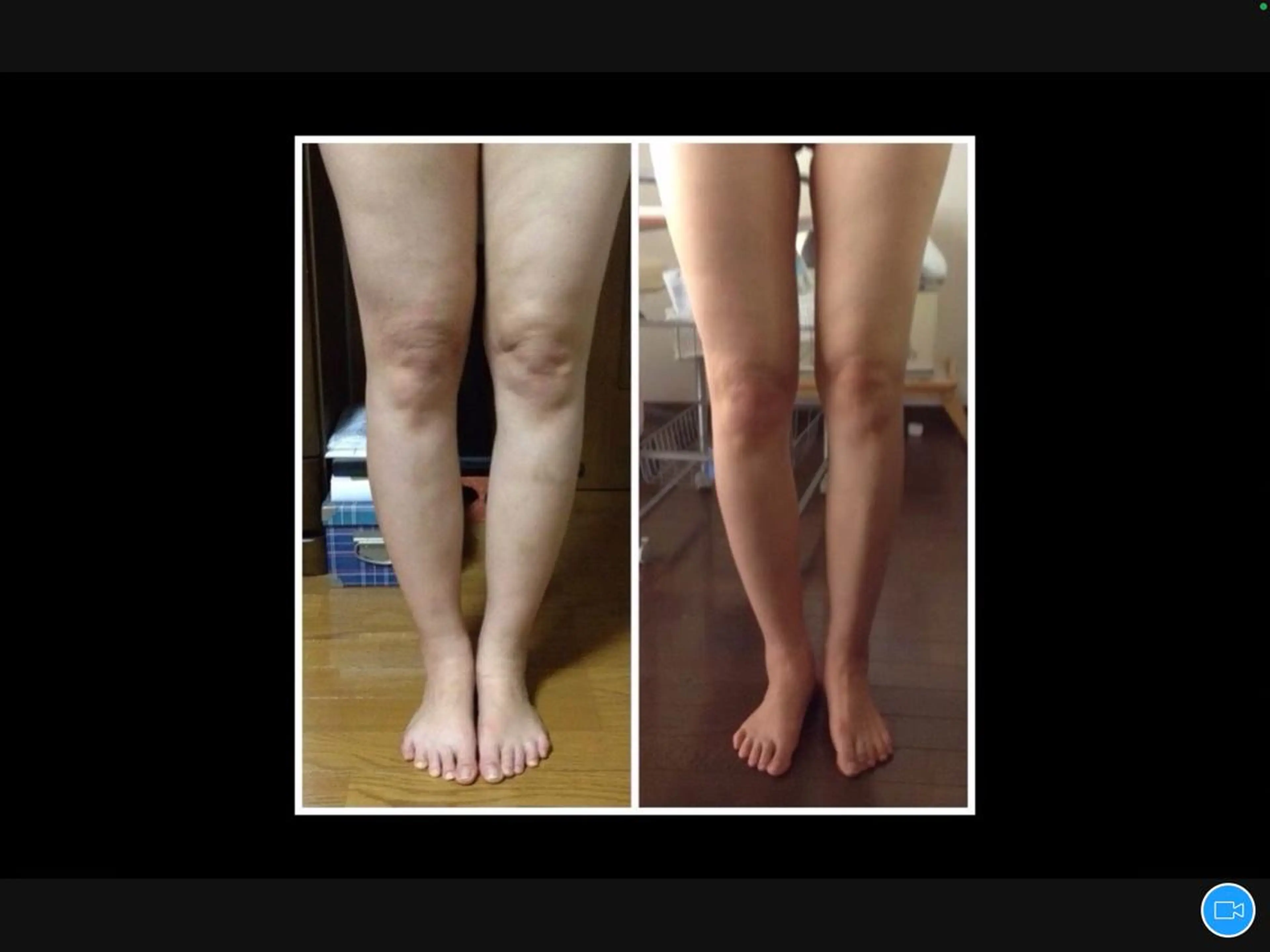 ○痛くないセル脂肪ケア　（脚）の写真