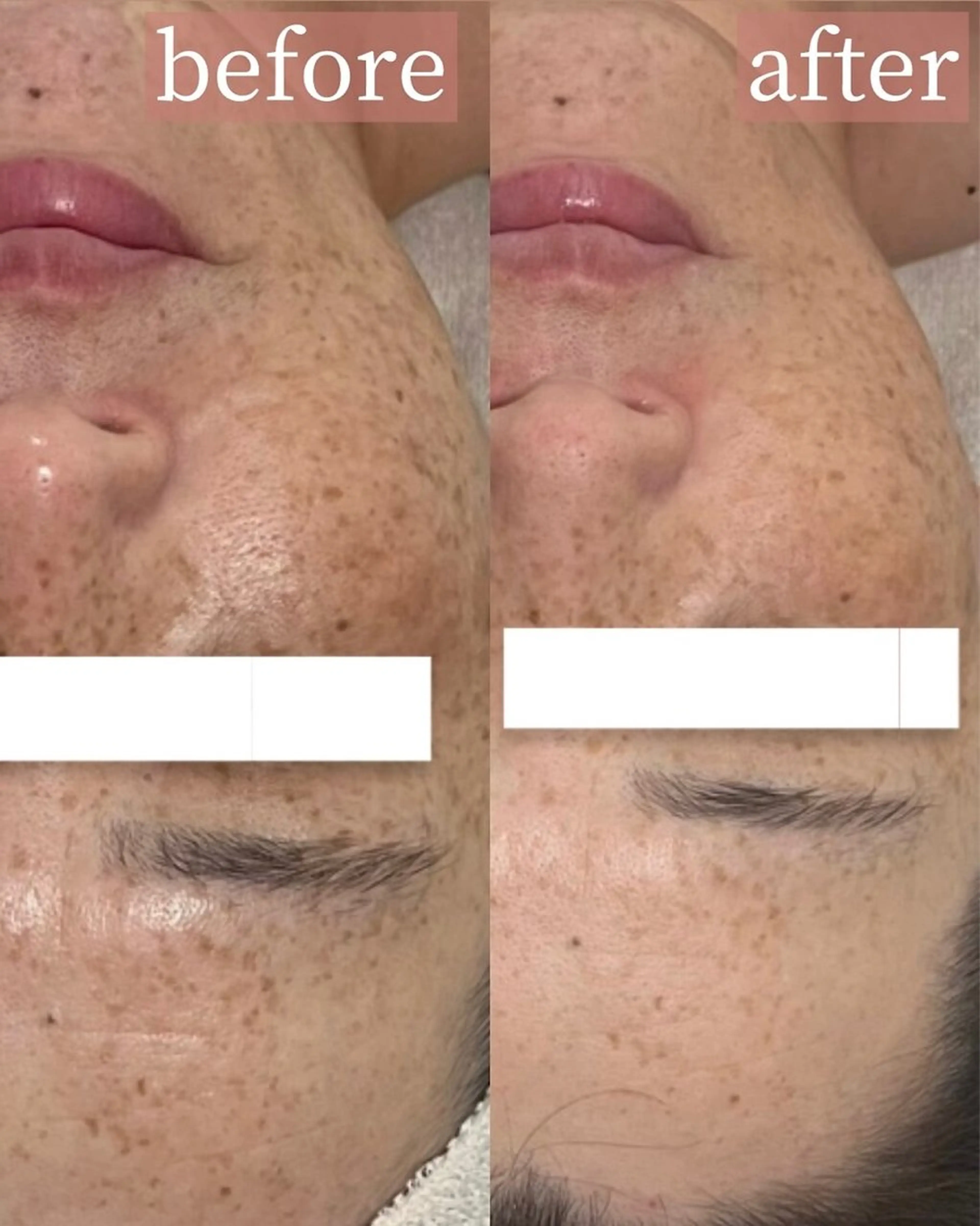 【ツヤ肌ピーリング】ラミネーションピール×ハイドロジェリーマスクの写真