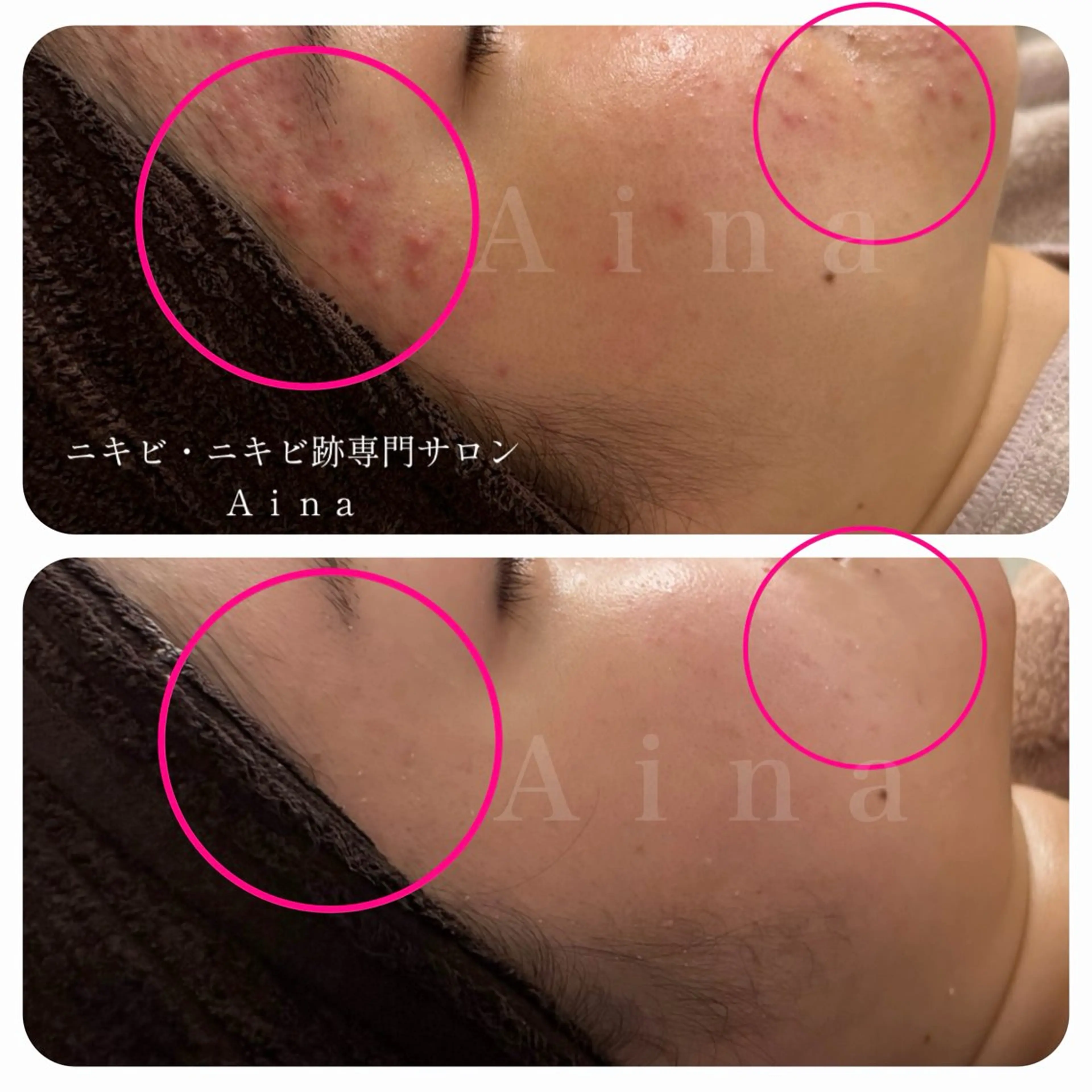 エステ リラク ニキビ跡専門サロン Ainaのエステ・リラクイメージ