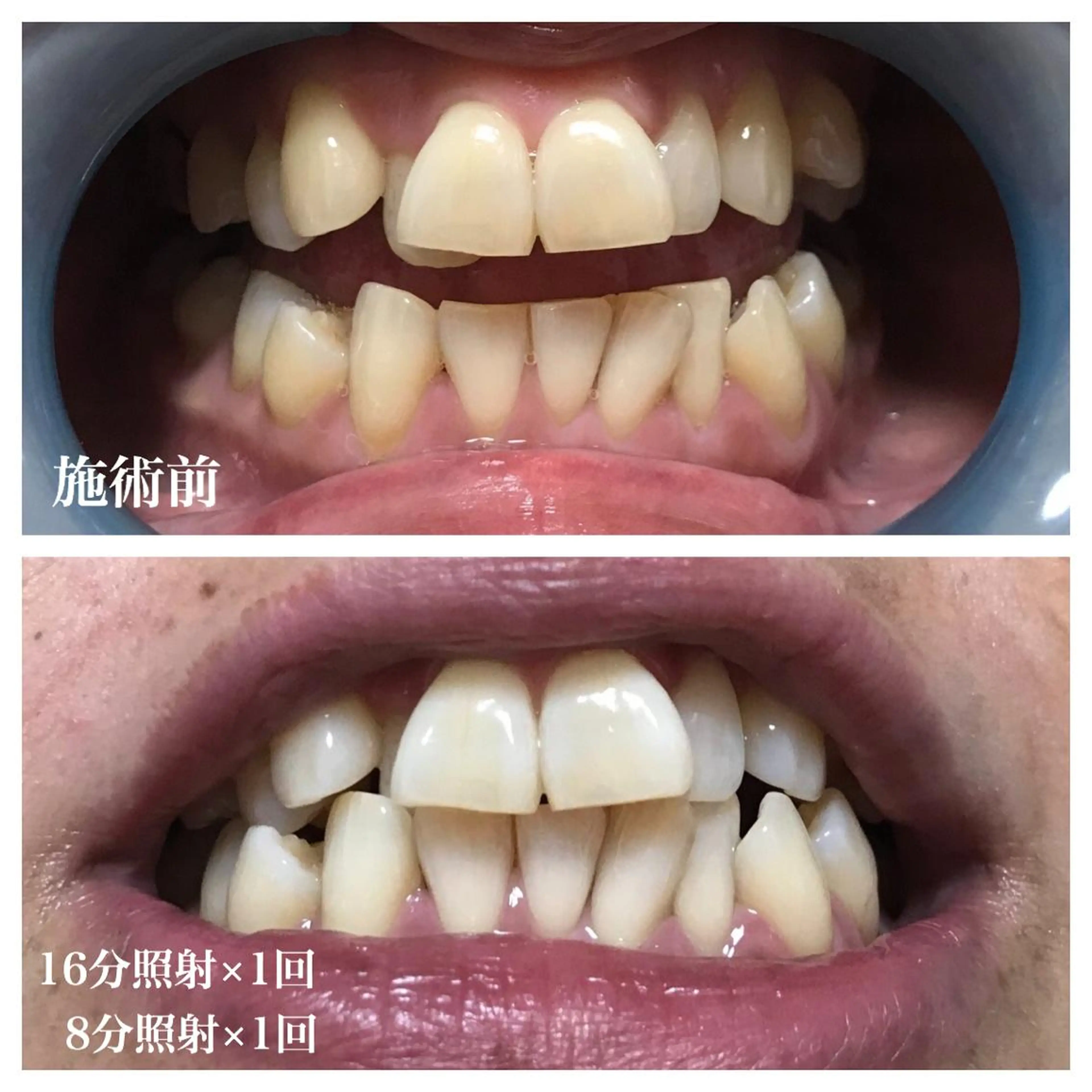 ネイル/耳つぼ /新ホワイトニングのネイルデザイン