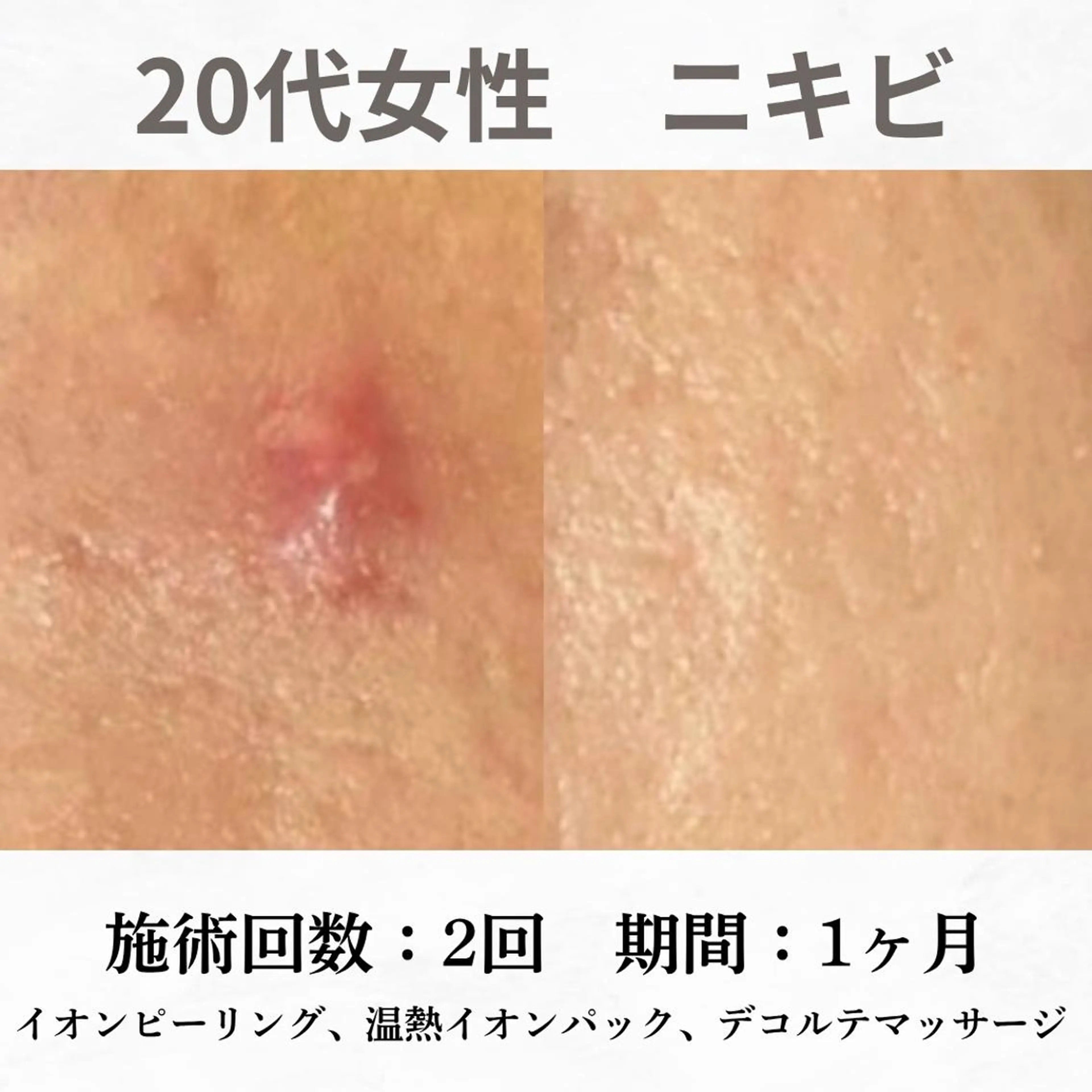 重度ニキビ専門🌷 ダウンタイムなしのエステ・リラクイメージ