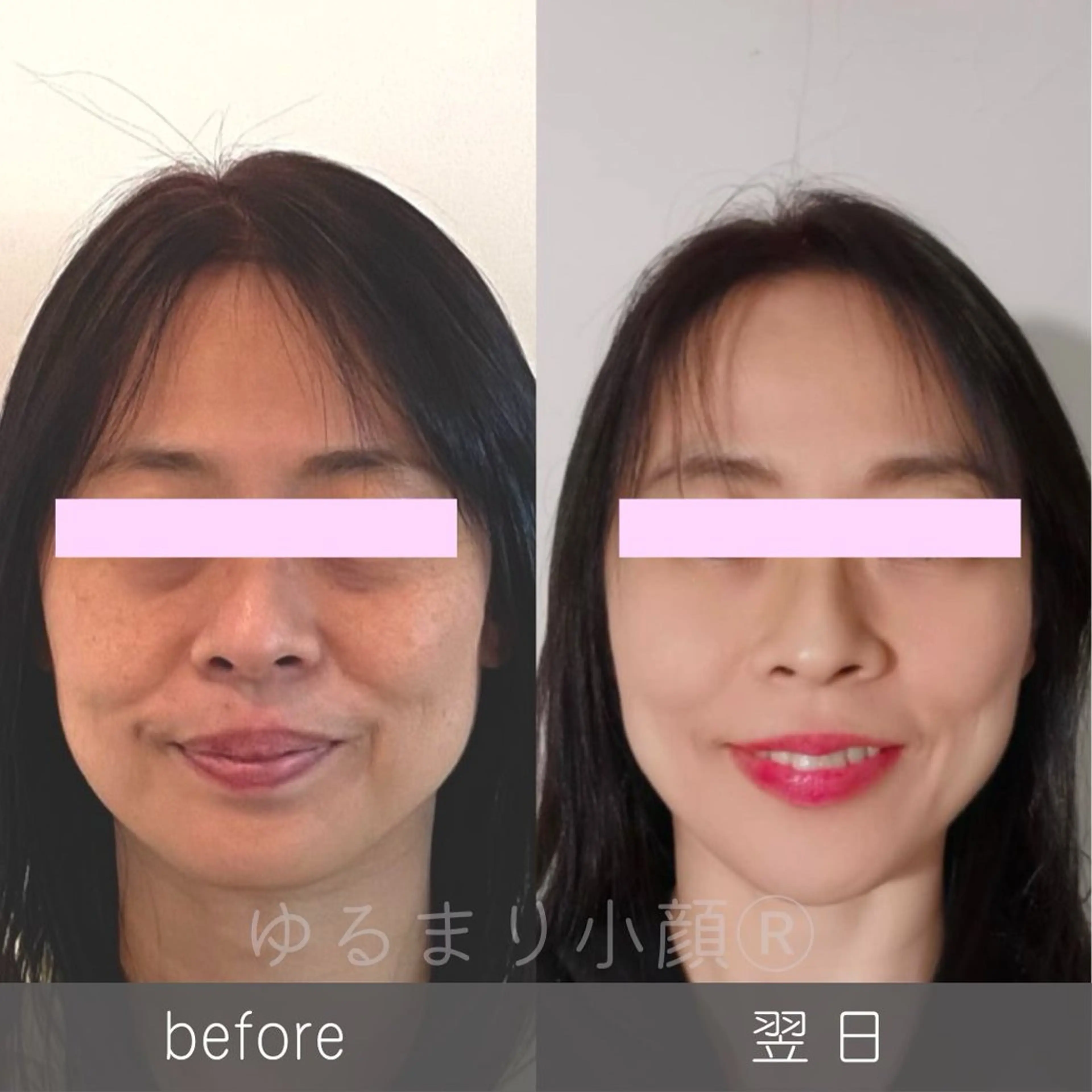 一番人気《たるみ卒業 》Vライン小顔へ！　優しいタッチの【頭蓋骨マッサージ×小顔フェイシャル】65分⭐︎半額の6500円の写真