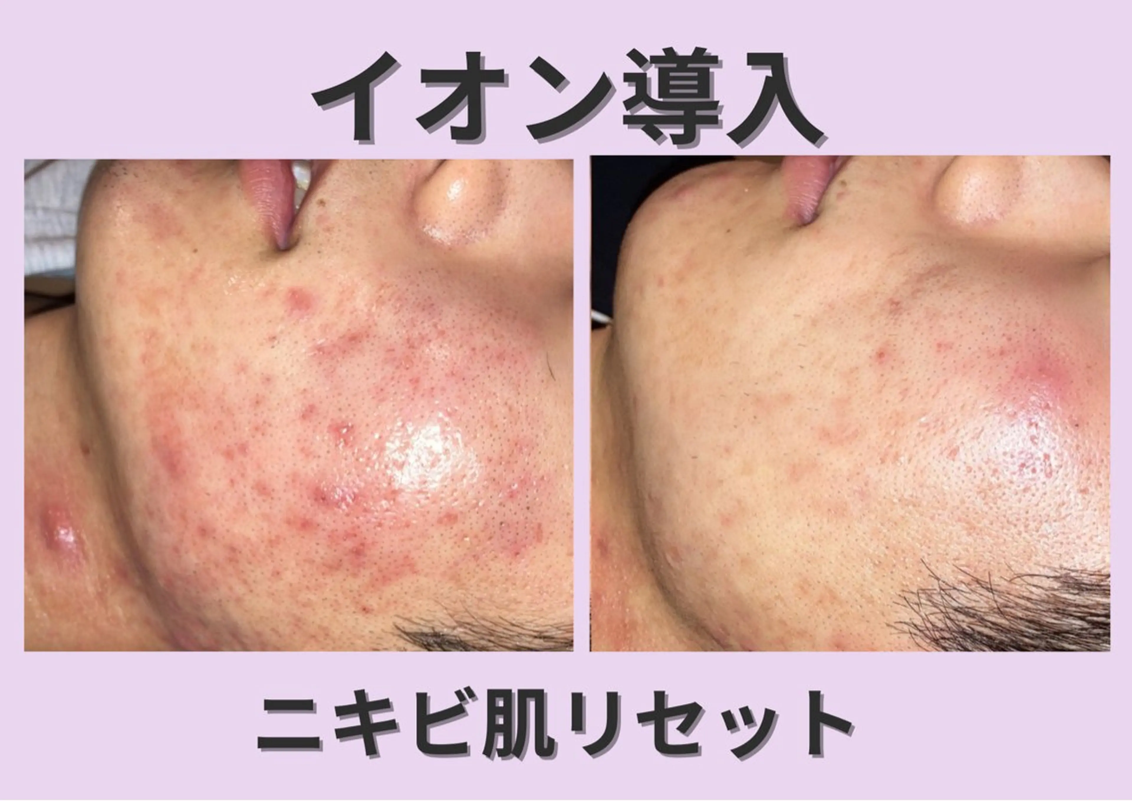 【卒業・入学前のニキビケア】荒れた肌を速攻鎮静✨高濃度ニキビケア美容液で肌トラブルを根本から改善！の写真