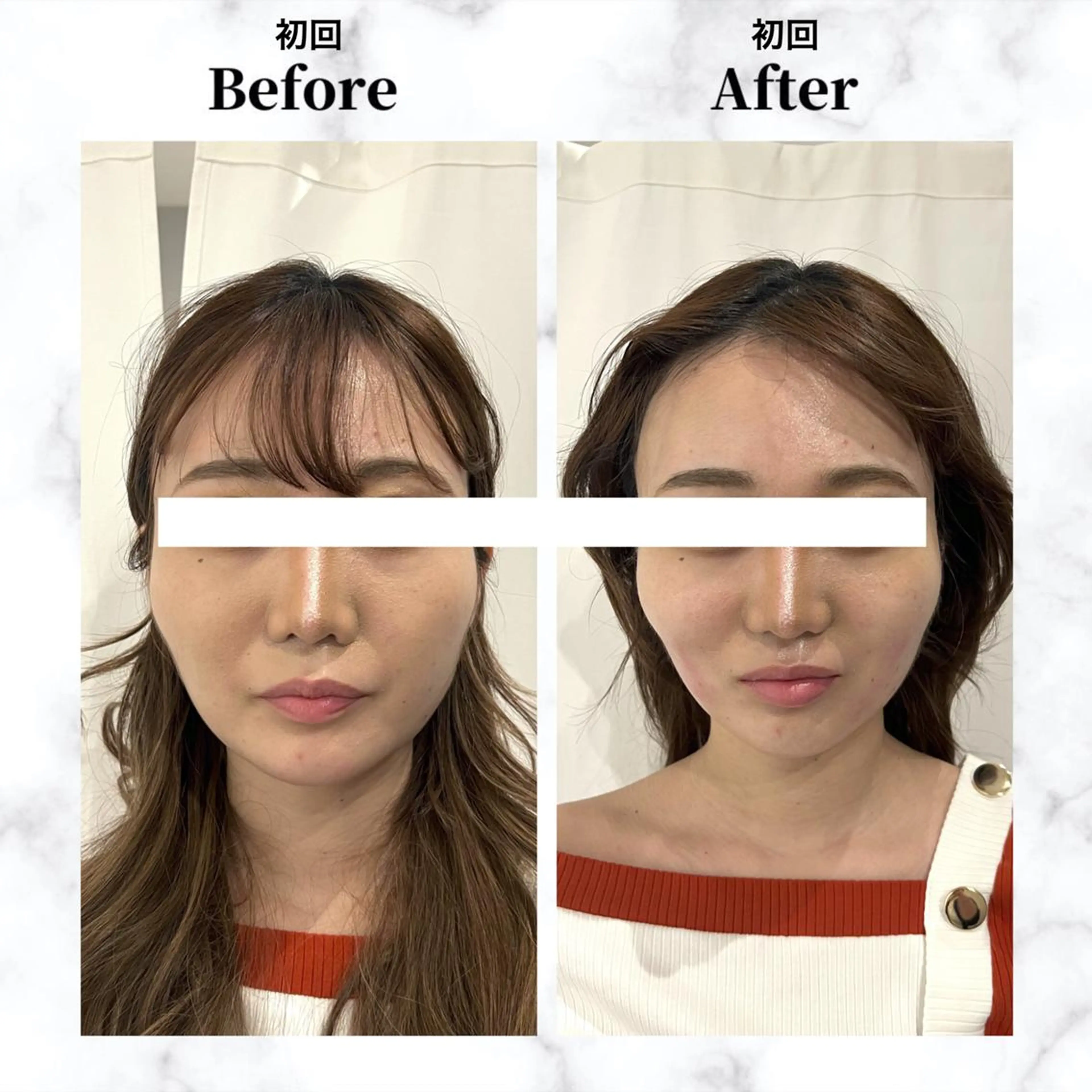 エステ リラク 12Dハイフ💗 最強小顔のエステ・リラクイメージ