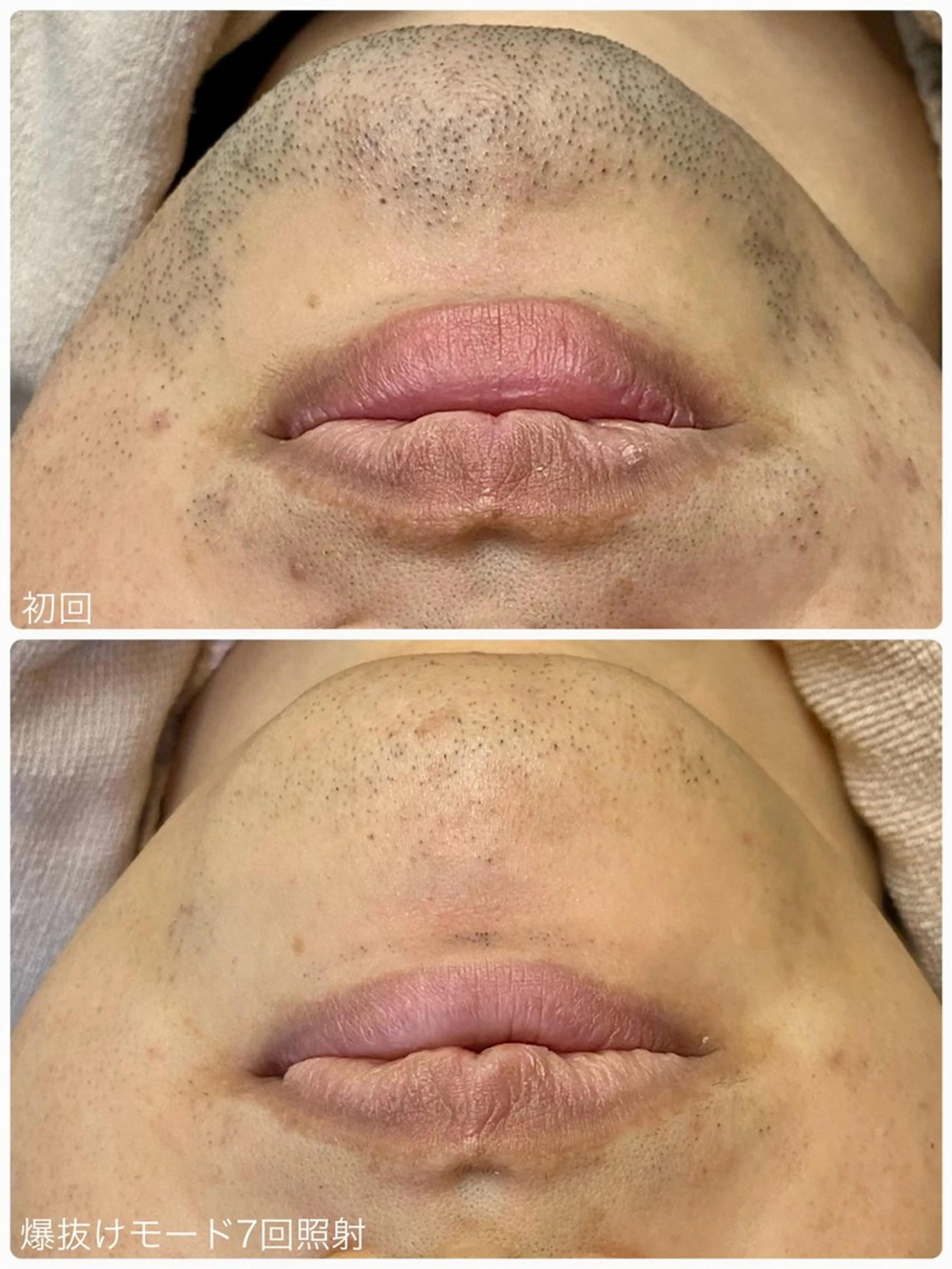 脱毛 Hisui 小出のエステ・リラクイメージ