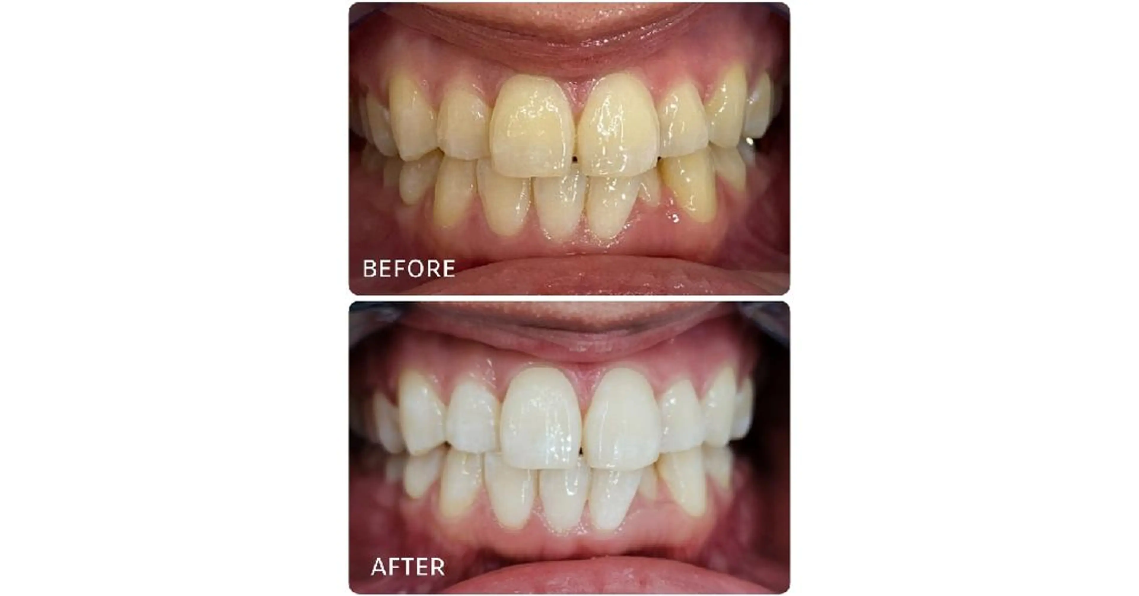 🔥ホワイトニング👑当店人気No.1☝🏻20分✖️20回コース🦷期限なし(現金払い)の写真