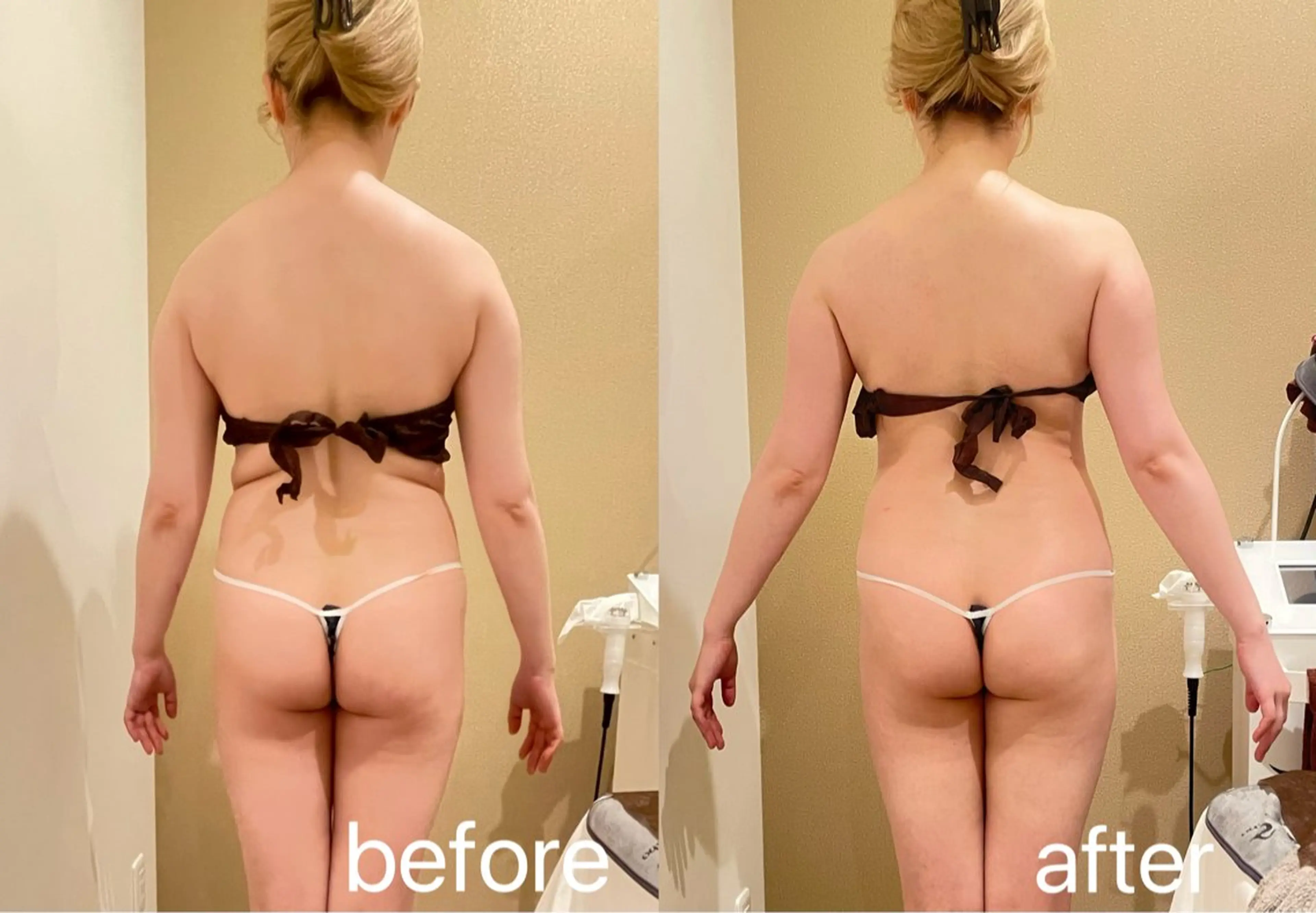 【ミニモ限定】即効✨二の腕、肩甲骨出すケア✨ハイパーナイフEX ➕リンパマッサージ 60分の写真