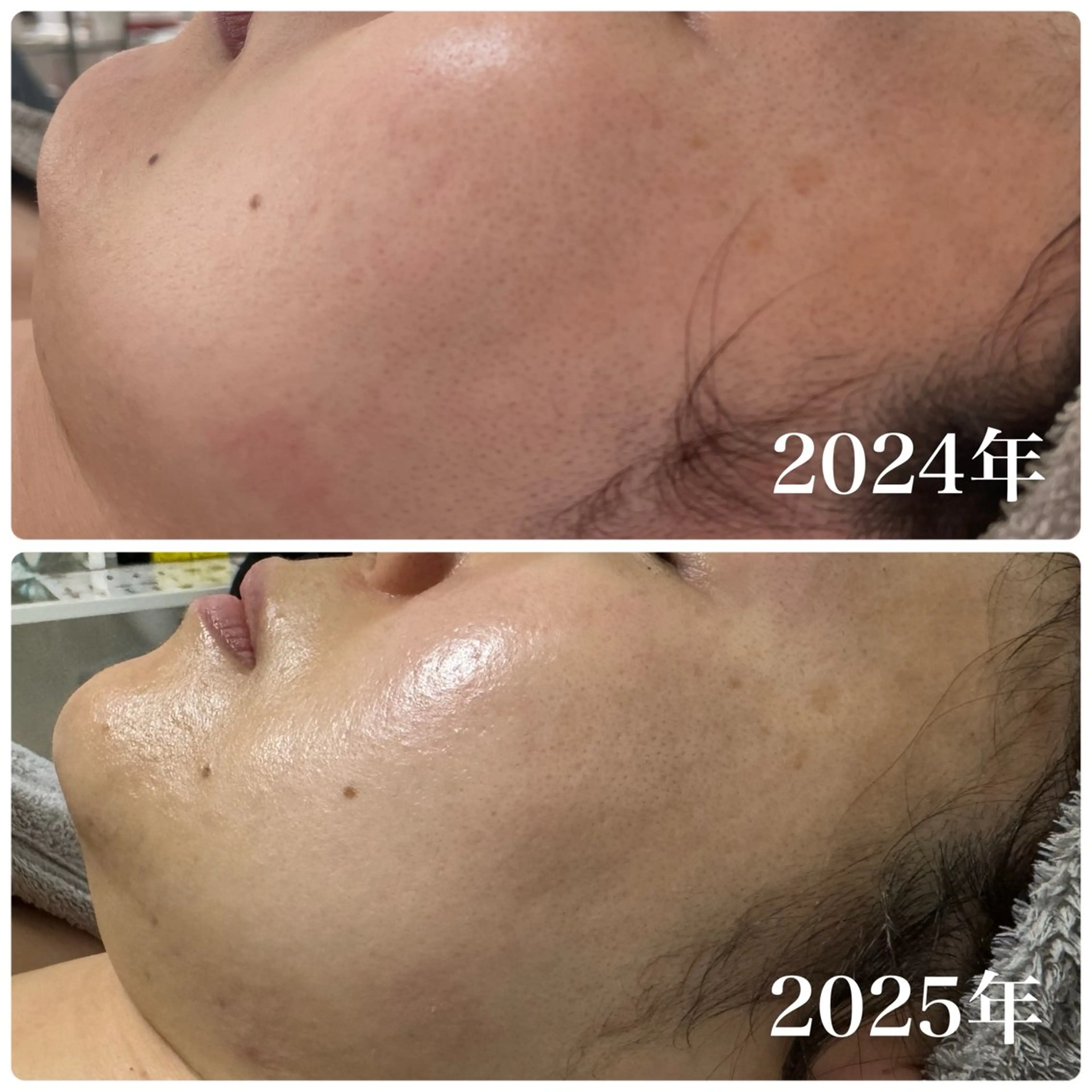 二重顎、ほうれい線、くすみ肌【小顔美肌フェイシャル】ハーブ×ハイパーナイフフェイシャル ¥18,700→¥14,000の写真